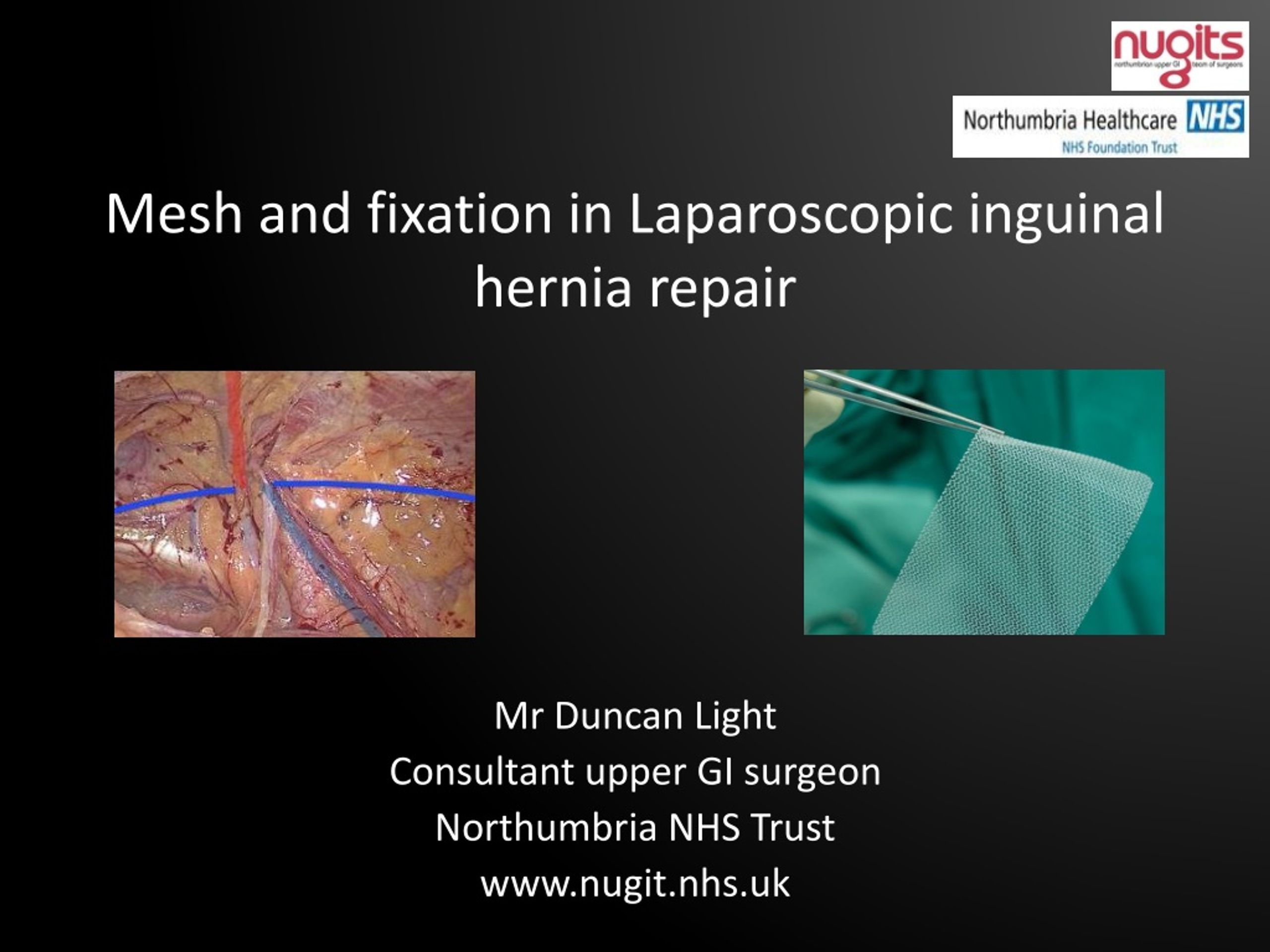 Ppt Mesh And Fixation In Laparoscopic Inguinal Hernia Repair Powerpoint Presentation Id8828497