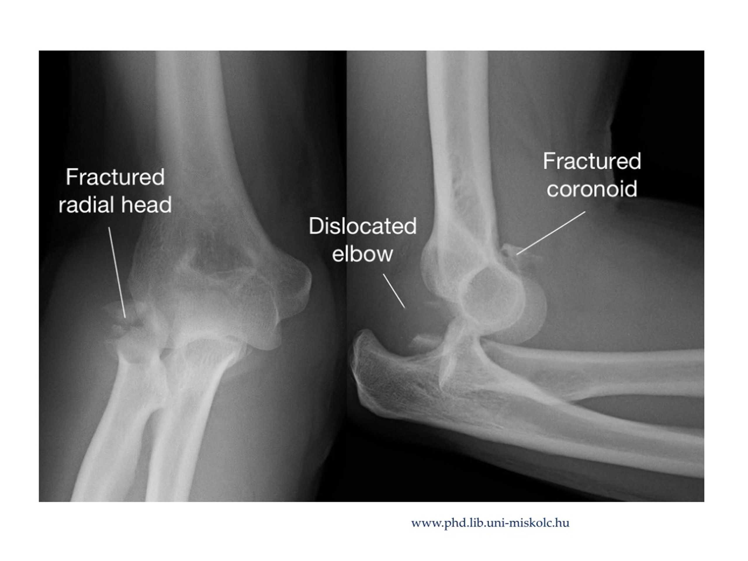 PPT - Elbow joint ( articulatio cubiti ) PowerPoint Presentation, free ...