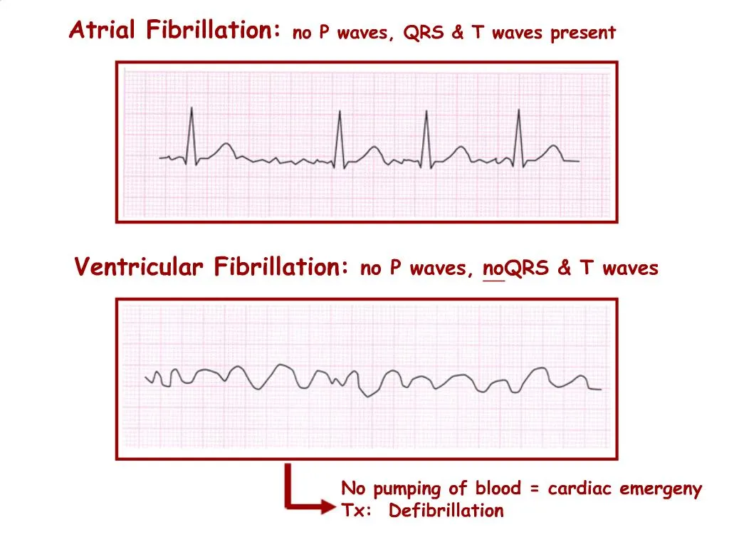 PPT - Atrial Fibrillation: no P waves, QRS T waves present PowerPoint ...