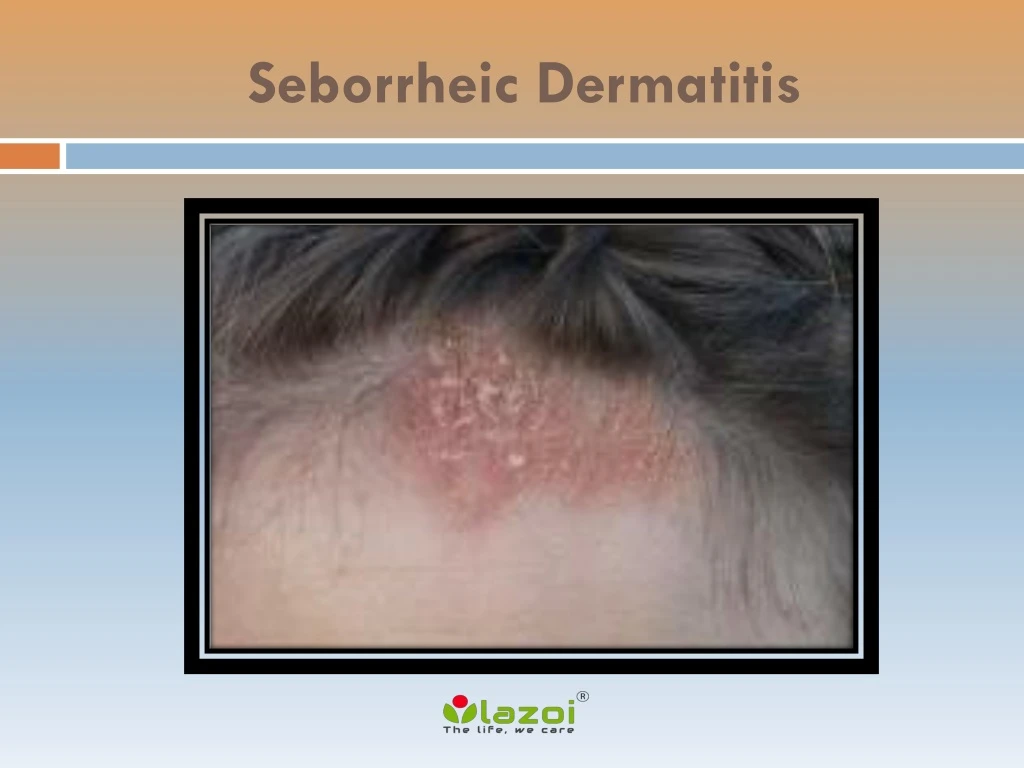 Ppt Seborrheic Dermatitis Powerpoint Presentation Id Hot Sex Picture