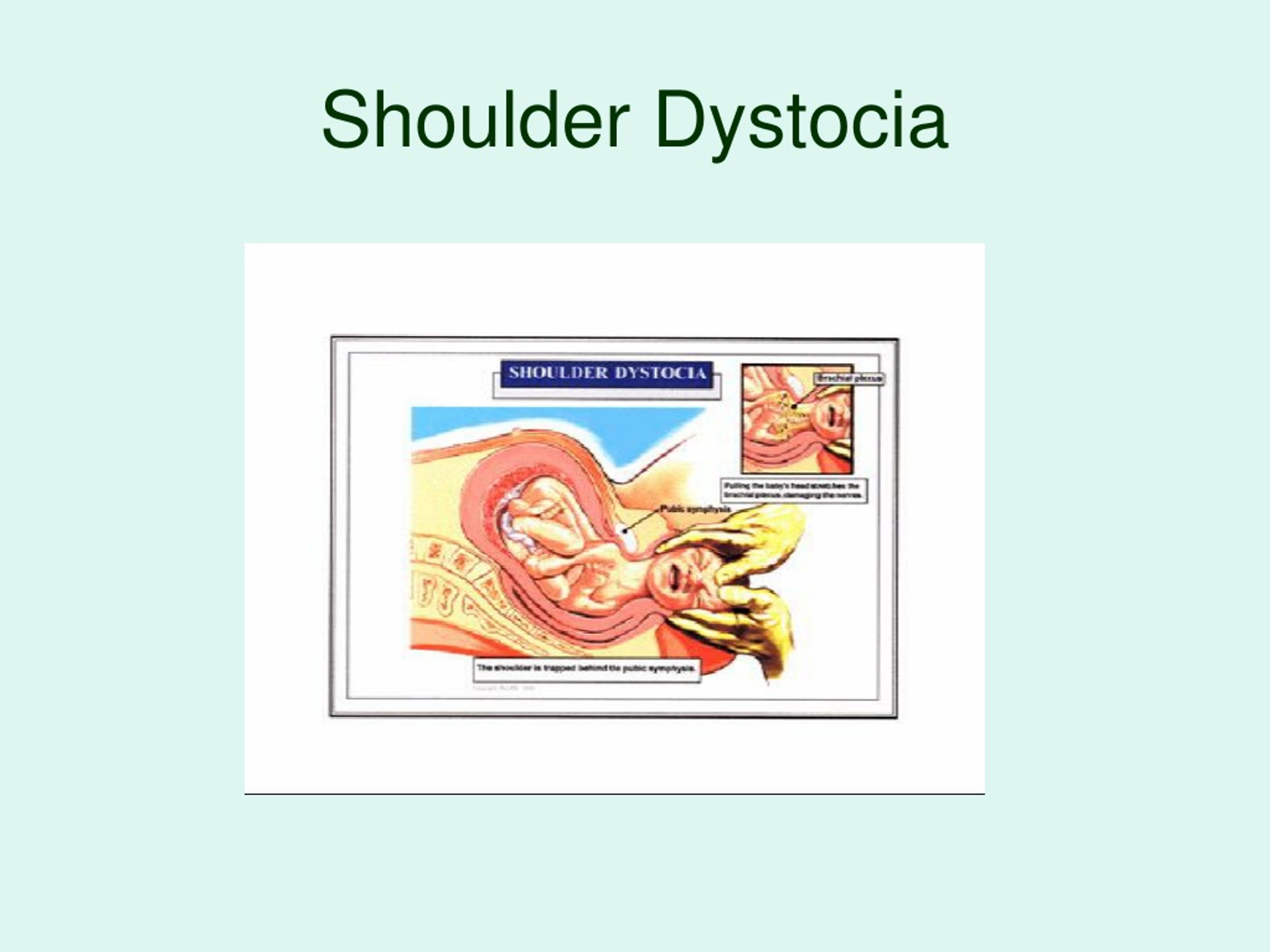 Ppt Dystocia Caused By Fetal Anomalies Powerpoint Presentation Free