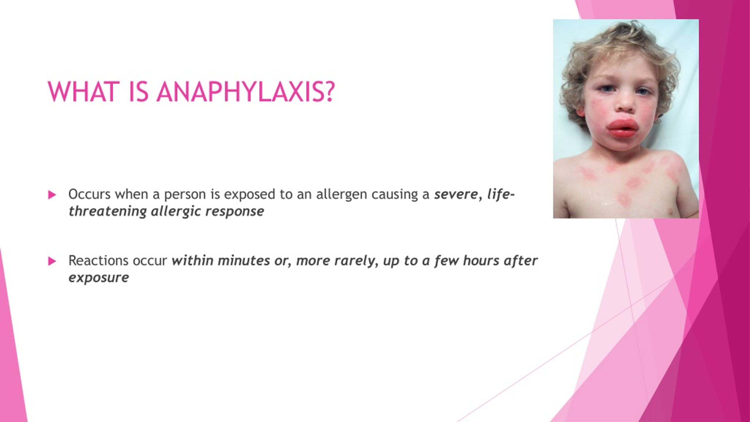 anaphylaxis presentation powerpoint uk