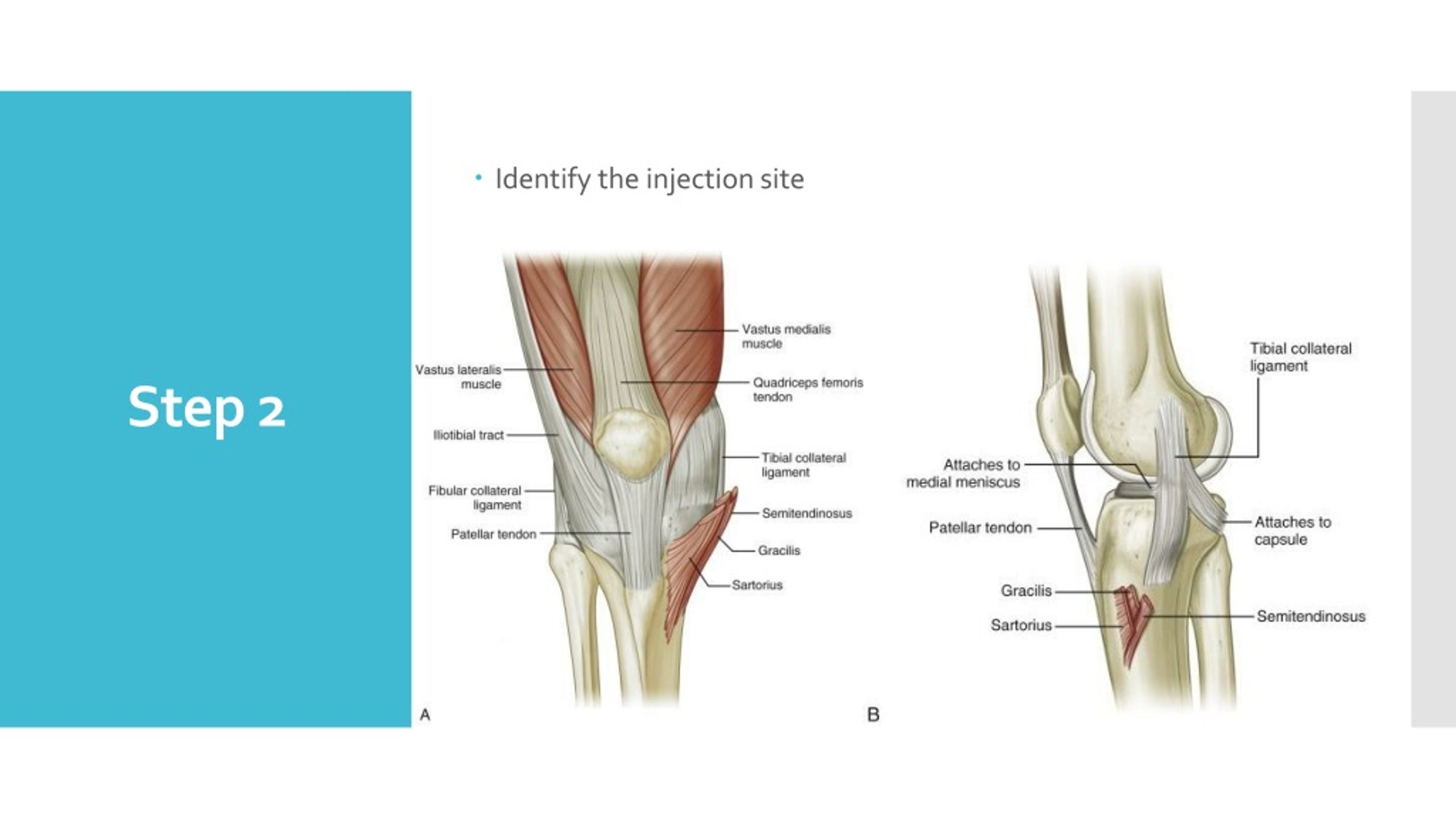 PPT - Intra-articular (IA) Injection -Osteoarthritis of the Knee ...