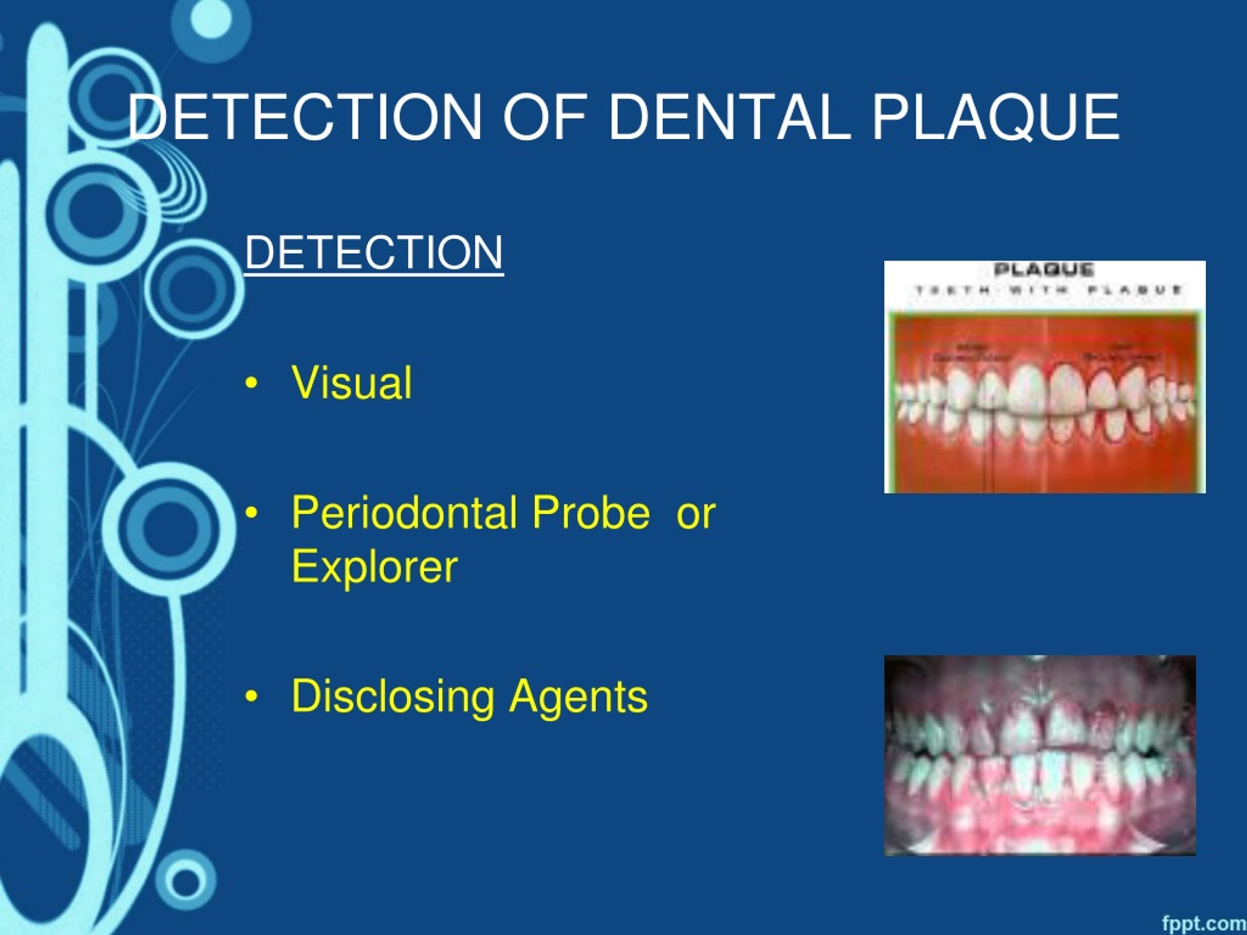 PPT - DENTAL PLAQUE PowerPoint Presentation, free download - ID:8924515