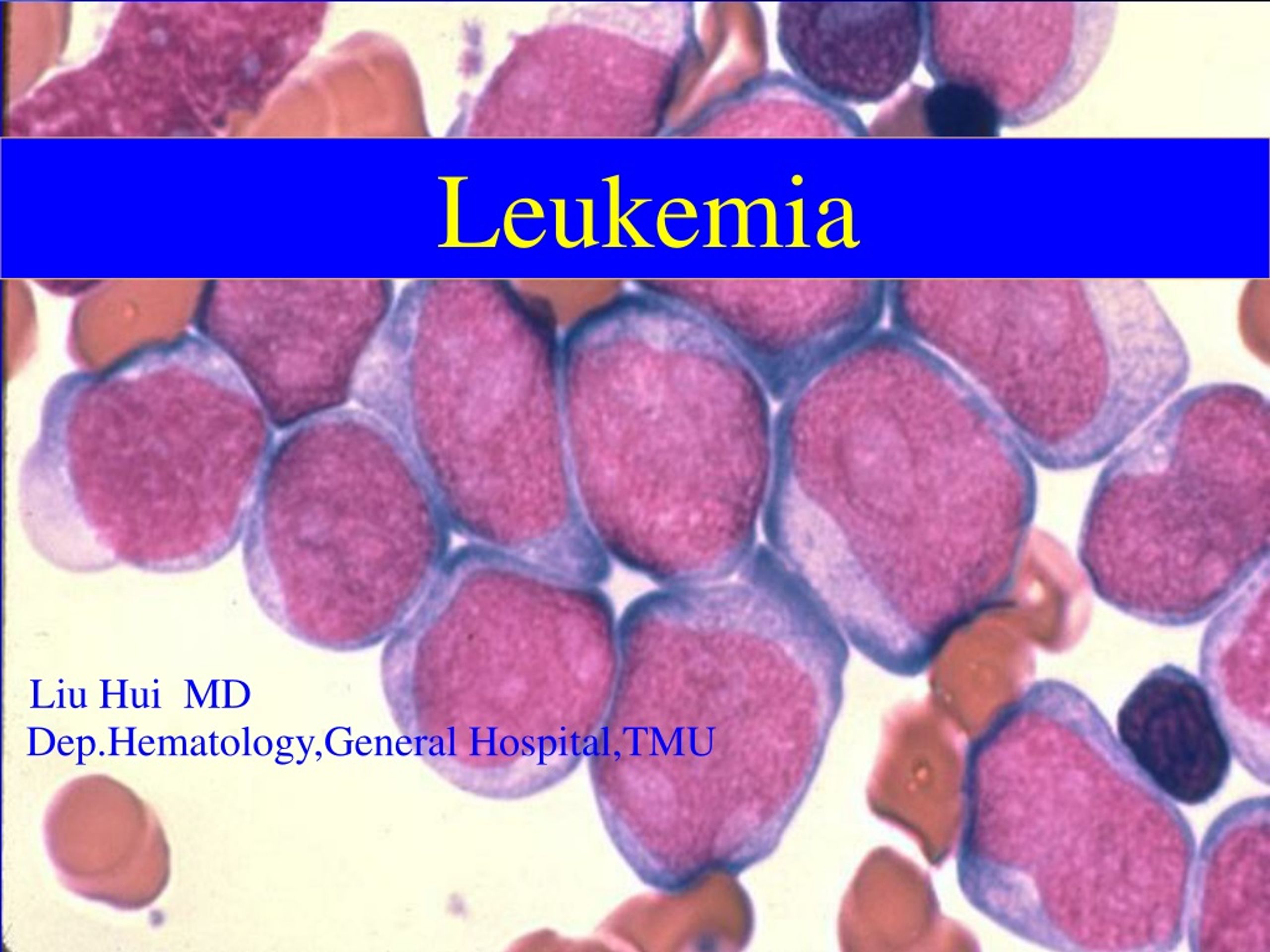 PPT - Leukemia PowerPoint Presentation, free download - ID:8959458