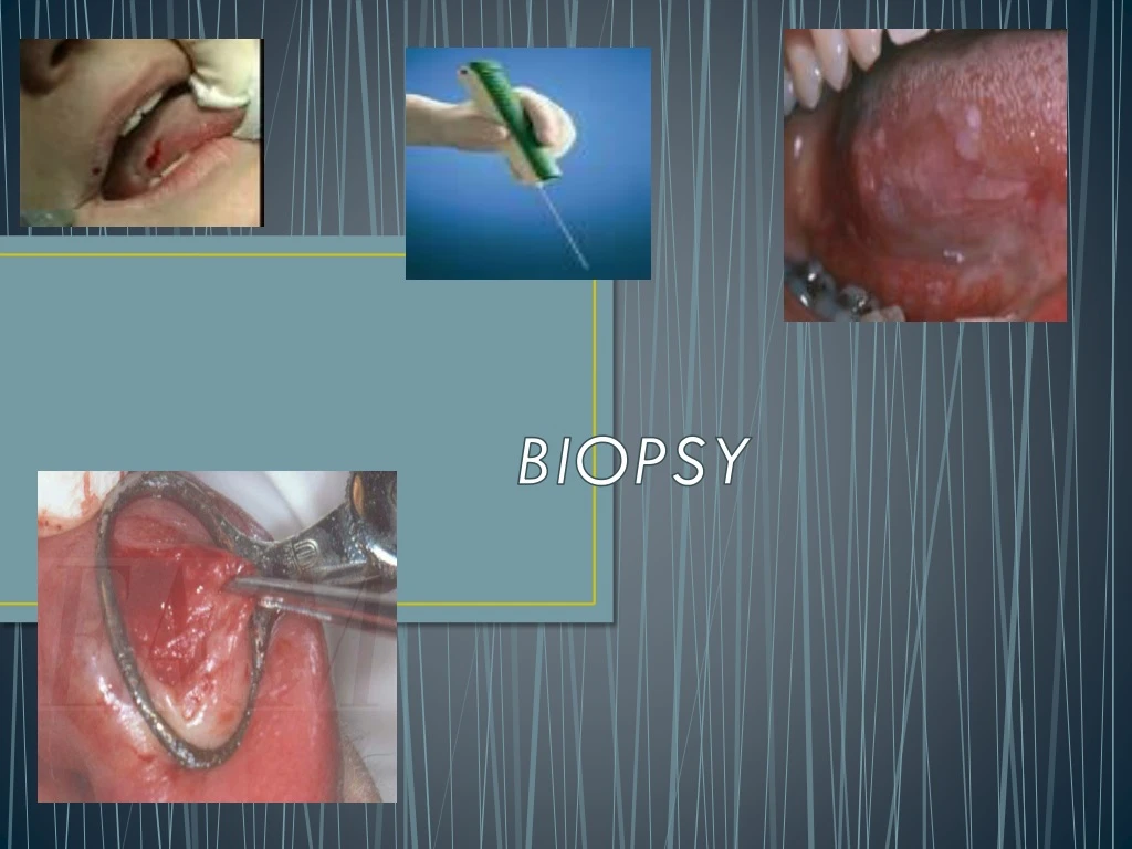 biopsy n.