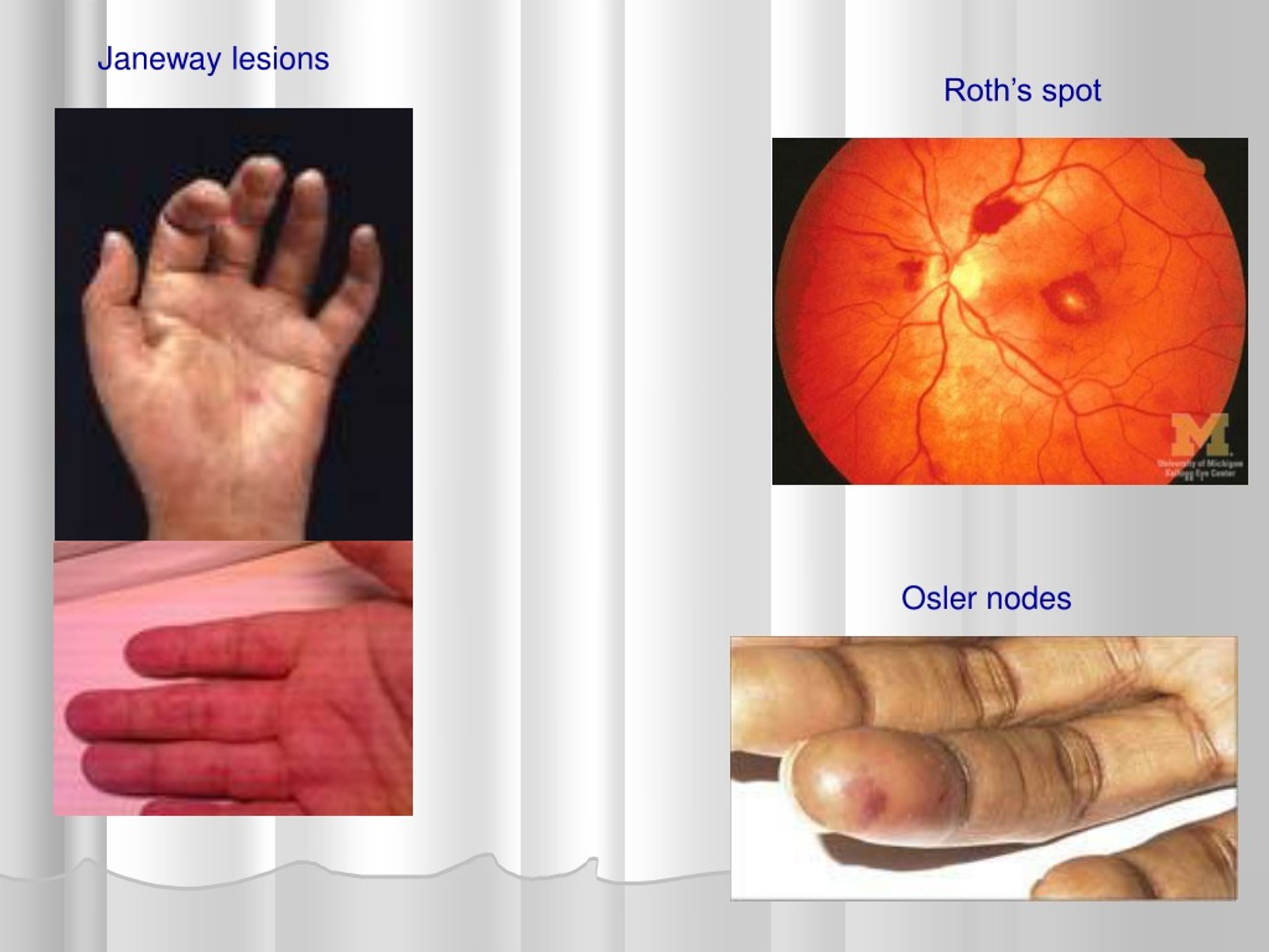 PPT - INFECTIVE ENDOCARDITIS IN CHILDREN PowerPoint Presentation, free ...