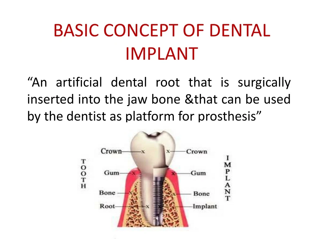 ppt-basic-concept-of-dental-implant-powerpoint-presentation-free