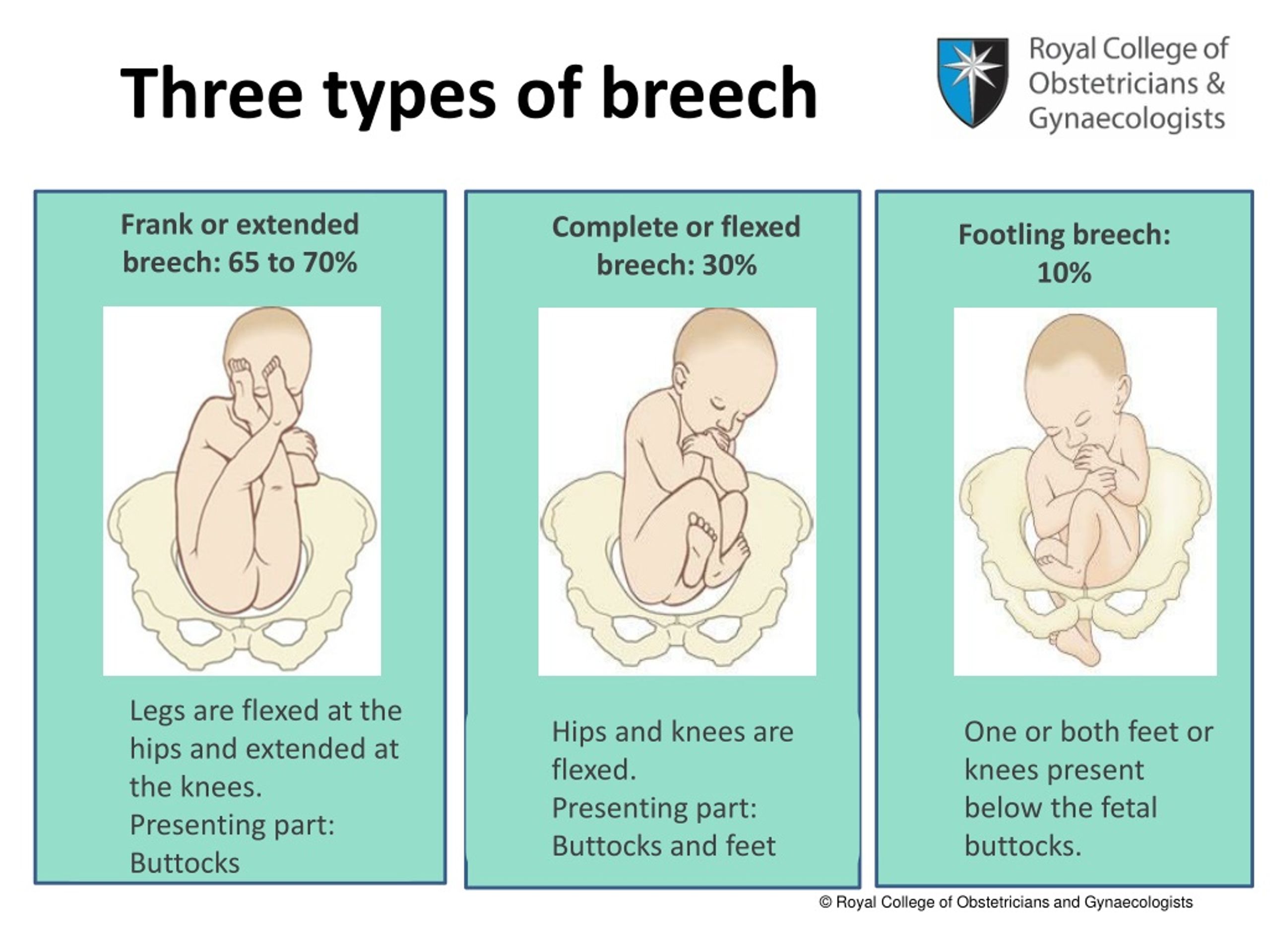 slideshare on breech presentation