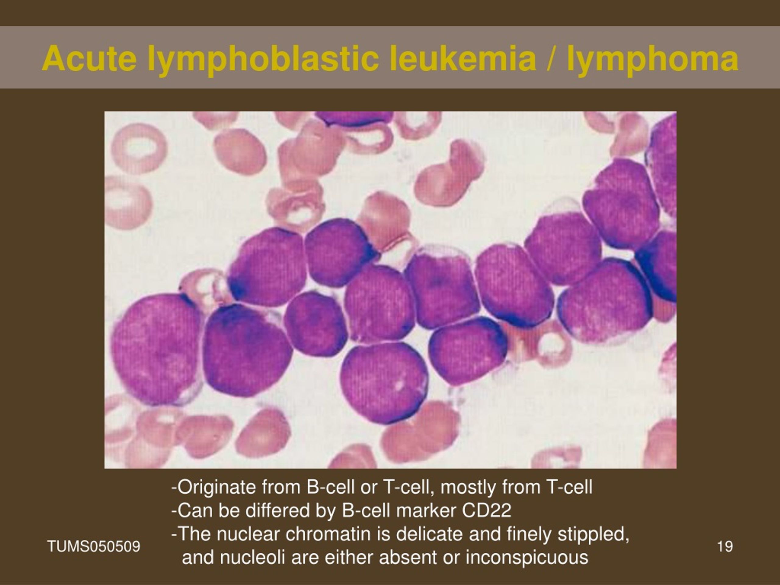 Ppt Lymphoid Neoplasm Powerpoint Presentation Free Download Id9074365 