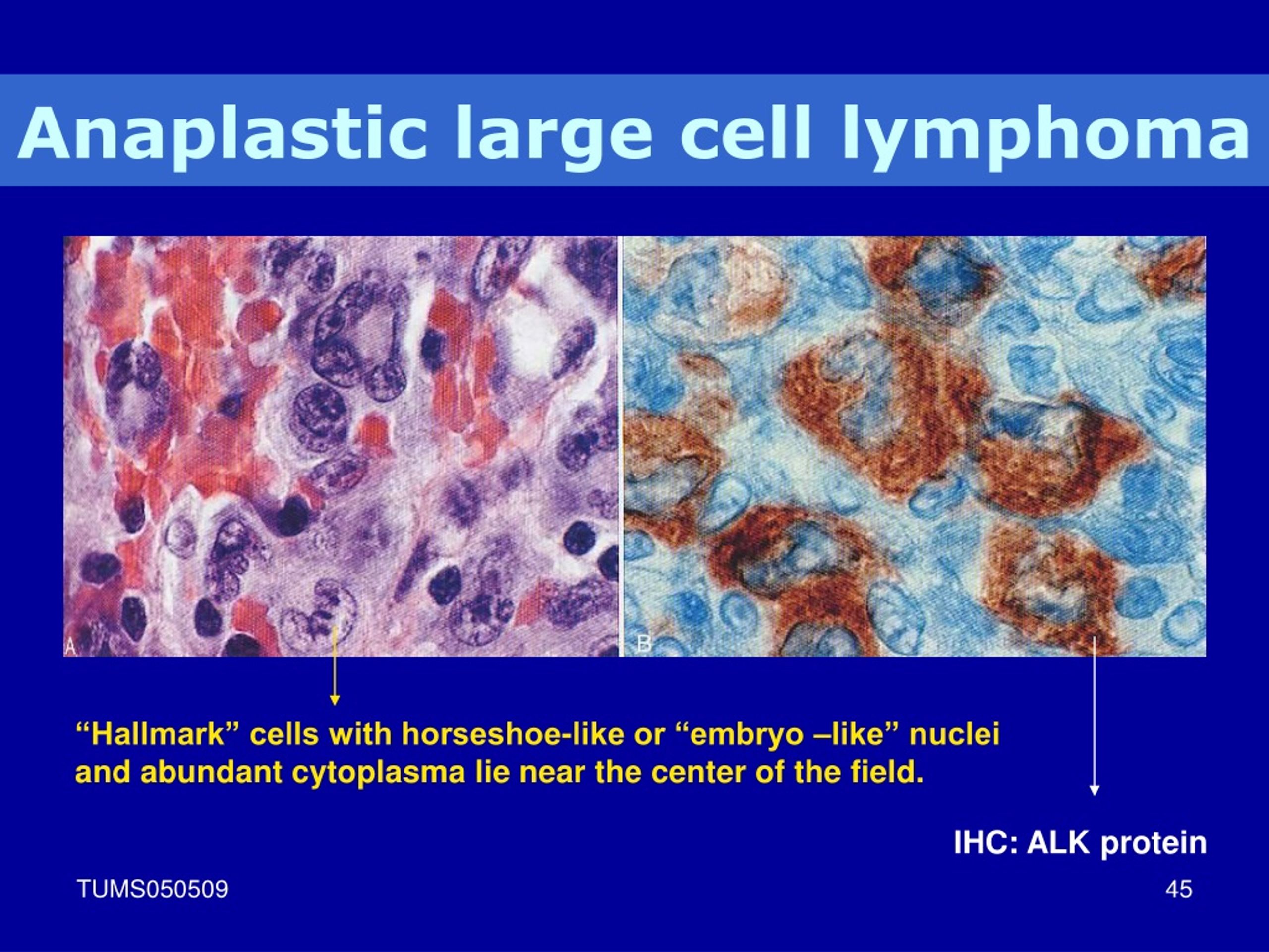 Ppt Lymphoid Neoplasm Powerpoint Presentation Free Download Id9074365 