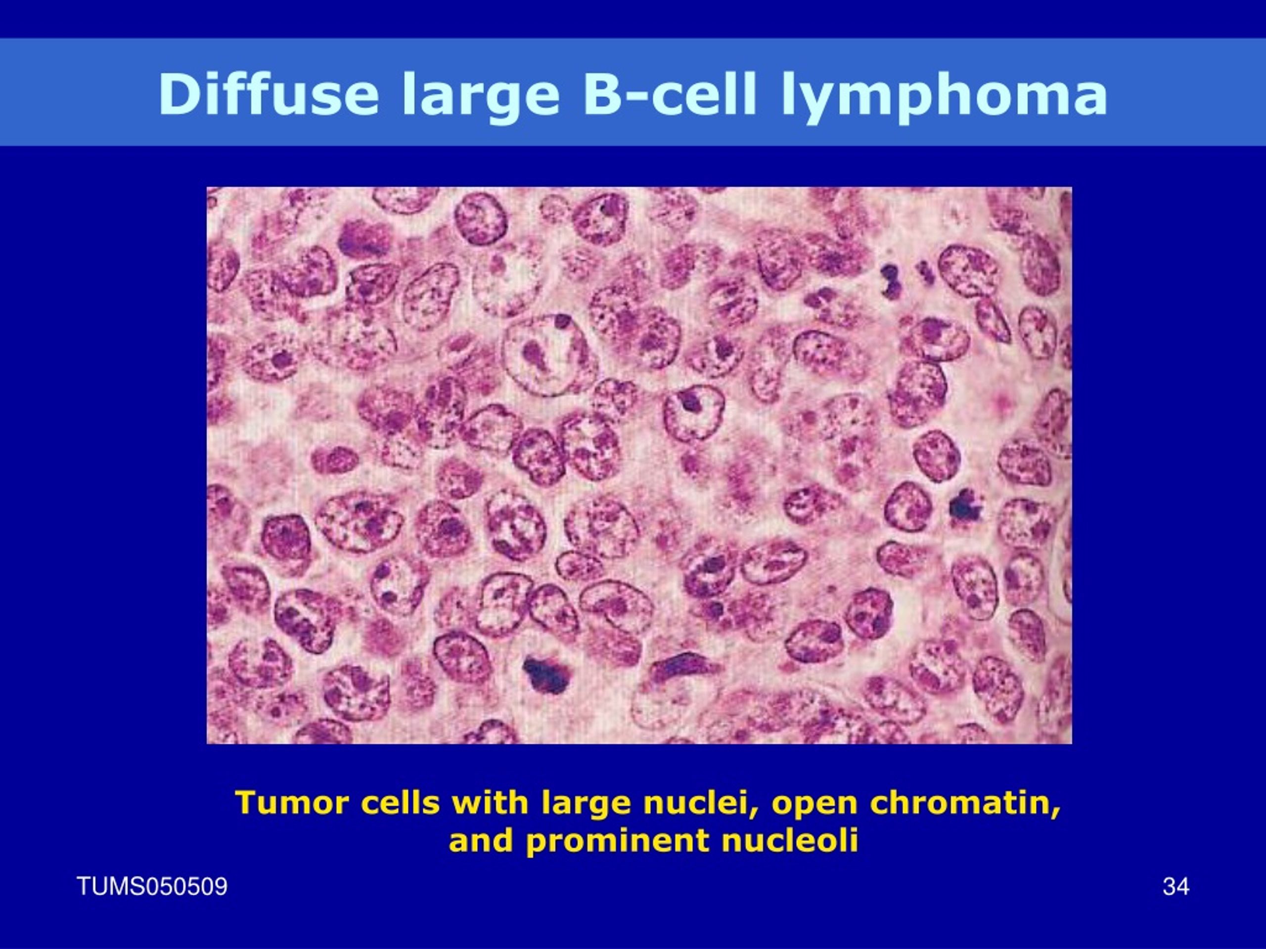 Ppt Lymphoid Neoplasm Powerpoint Presentation Free Download Id9074365 