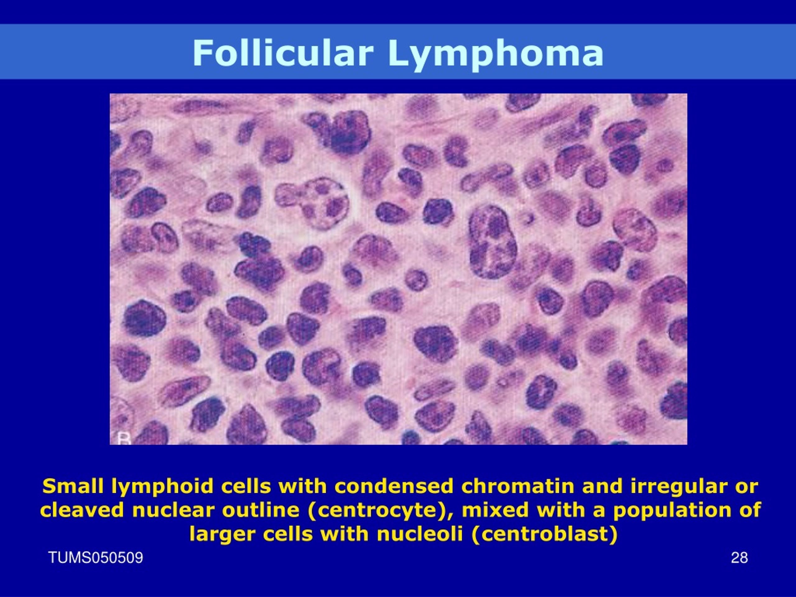 Ppt Lymphoid Neoplasm Powerpoint Presentation Free Download Id9074365 