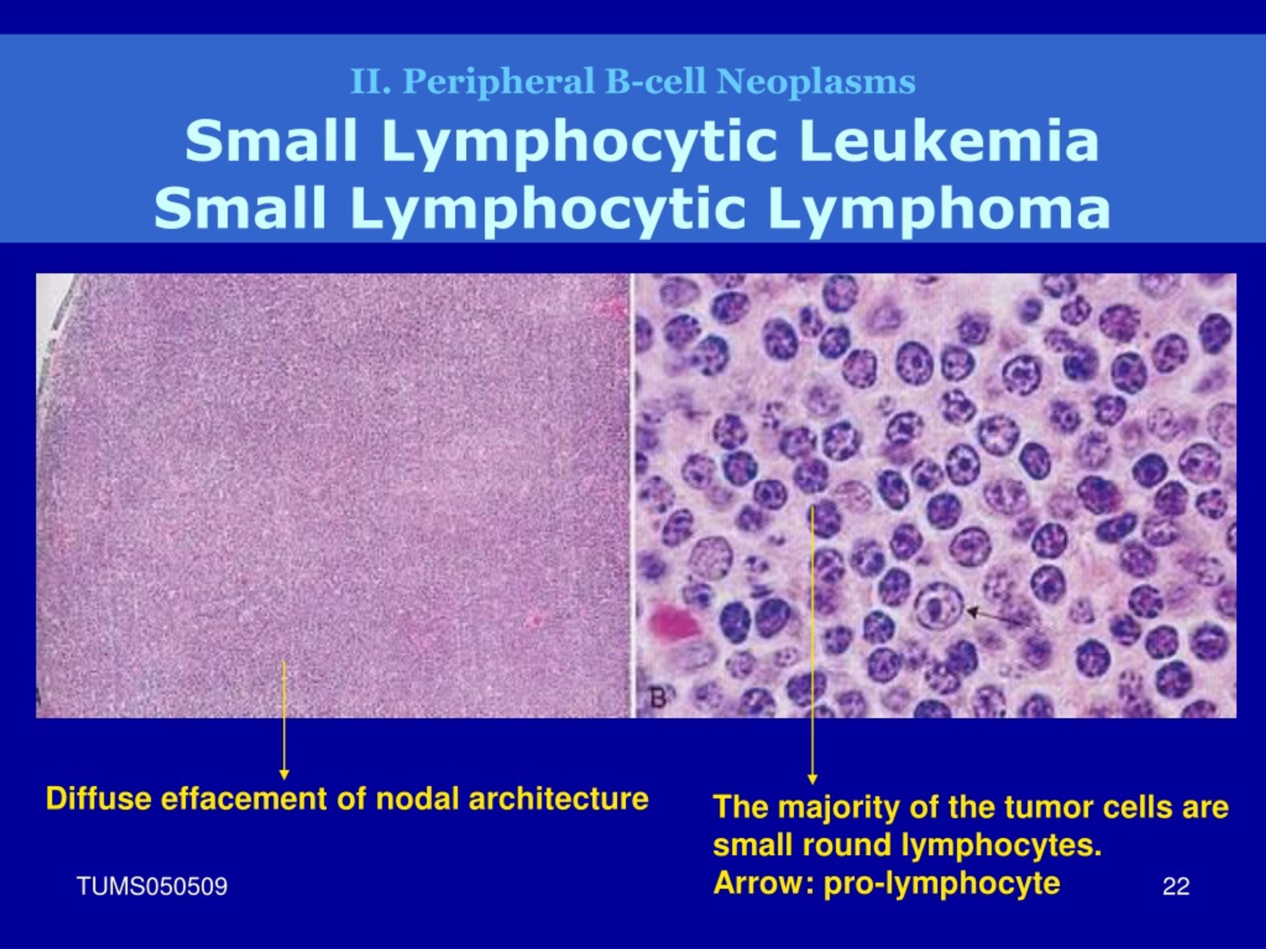 Ppt Lymphoid Neoplasm Powerpoint Presentation Free Download Id9074365 