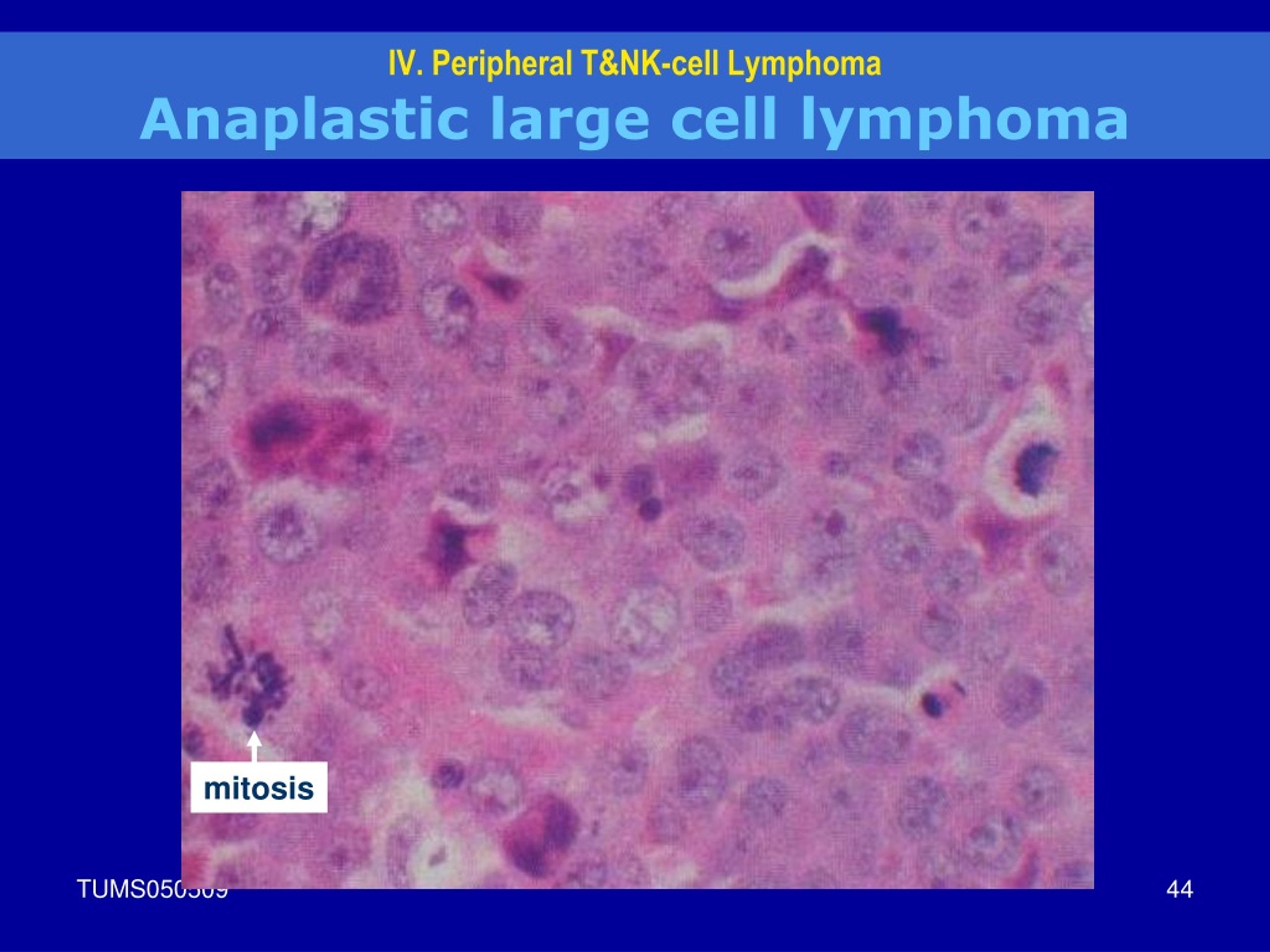 Ppt Lymphoid Neoplasm Powerpoint Presentation Free Download Id9074365 