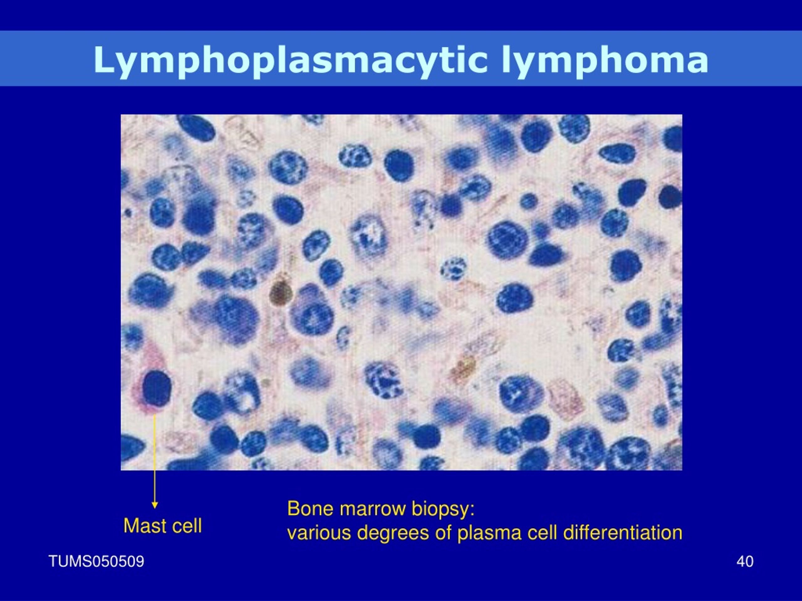 Ppt Lymphoid Neoplasm Powerpoint Presentation Free Download Id9074365 