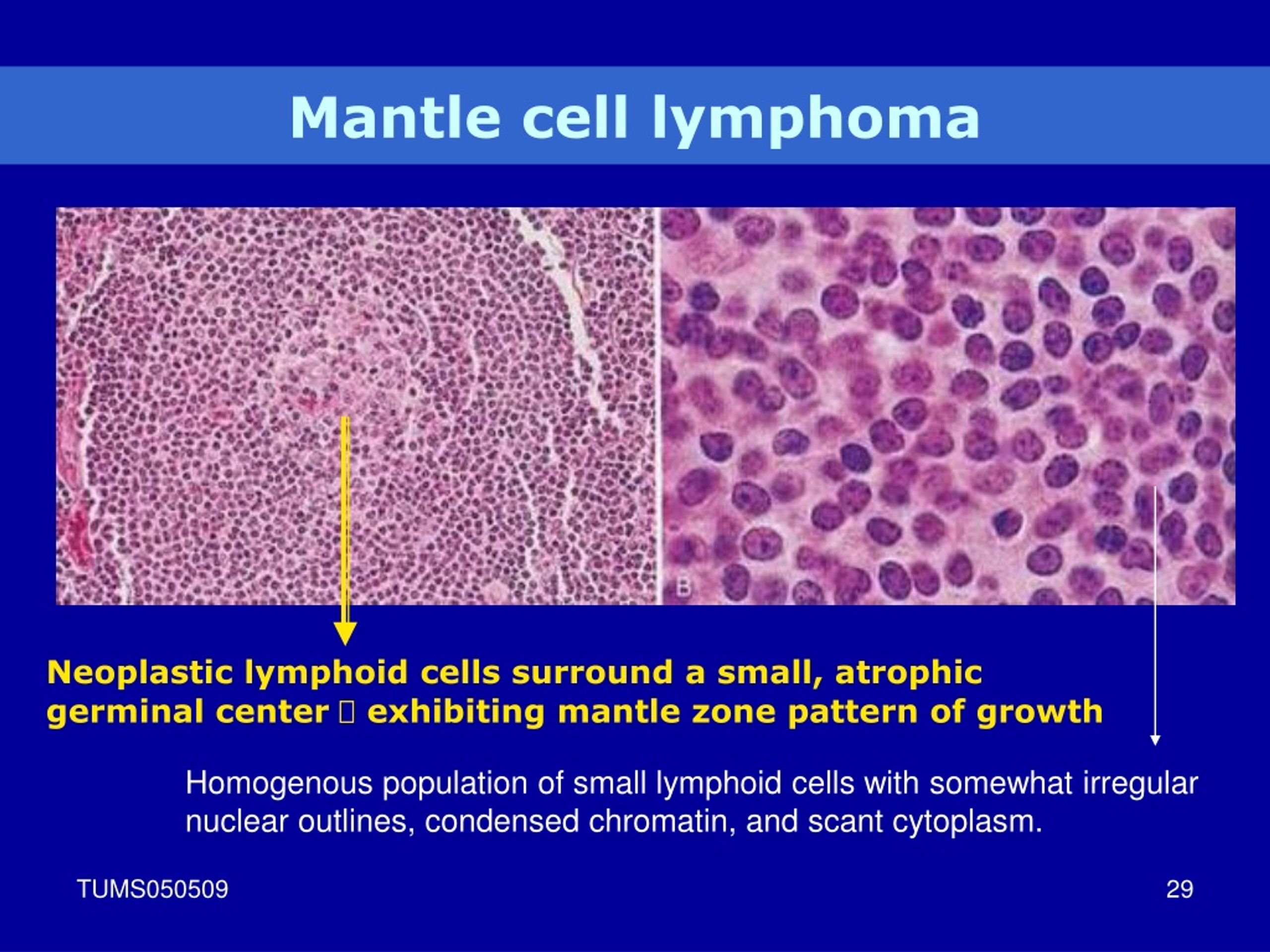 Ppt Lymphoid Neoplasm Powerpoint Presentation Free Download Id9074365 