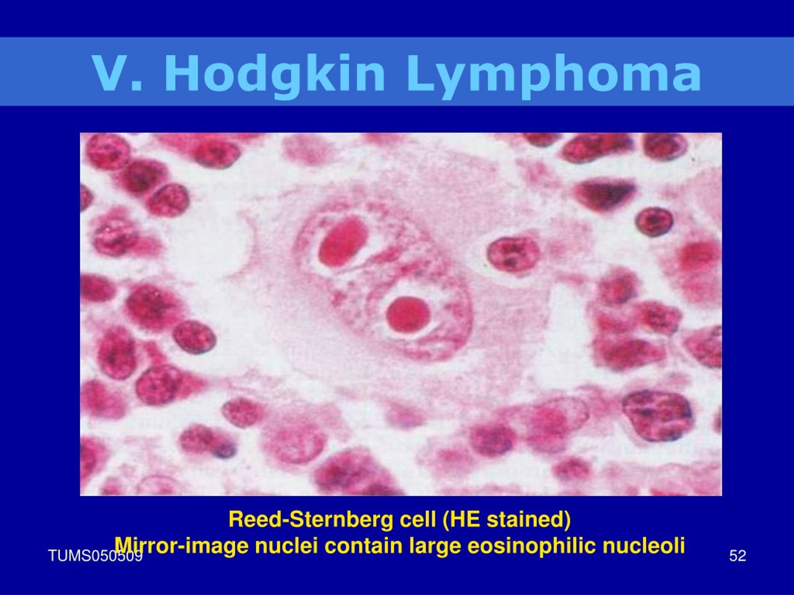 Ppt Lymphoid Neoplasm Powerpoint Presentation Free Download Id9074365 