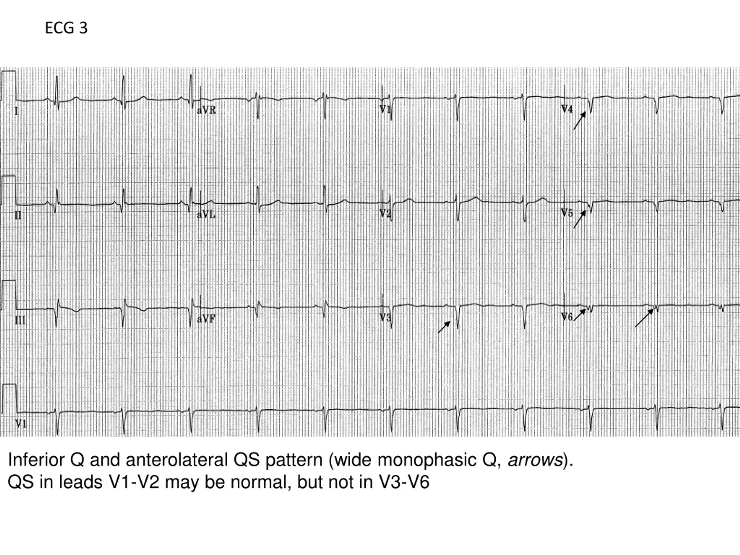 PPT ECG Interpretation For Cardiology Cases PowerPoint Presentation PPT ECG Interpretation For Cardiology Cases PowerPoint Presentation