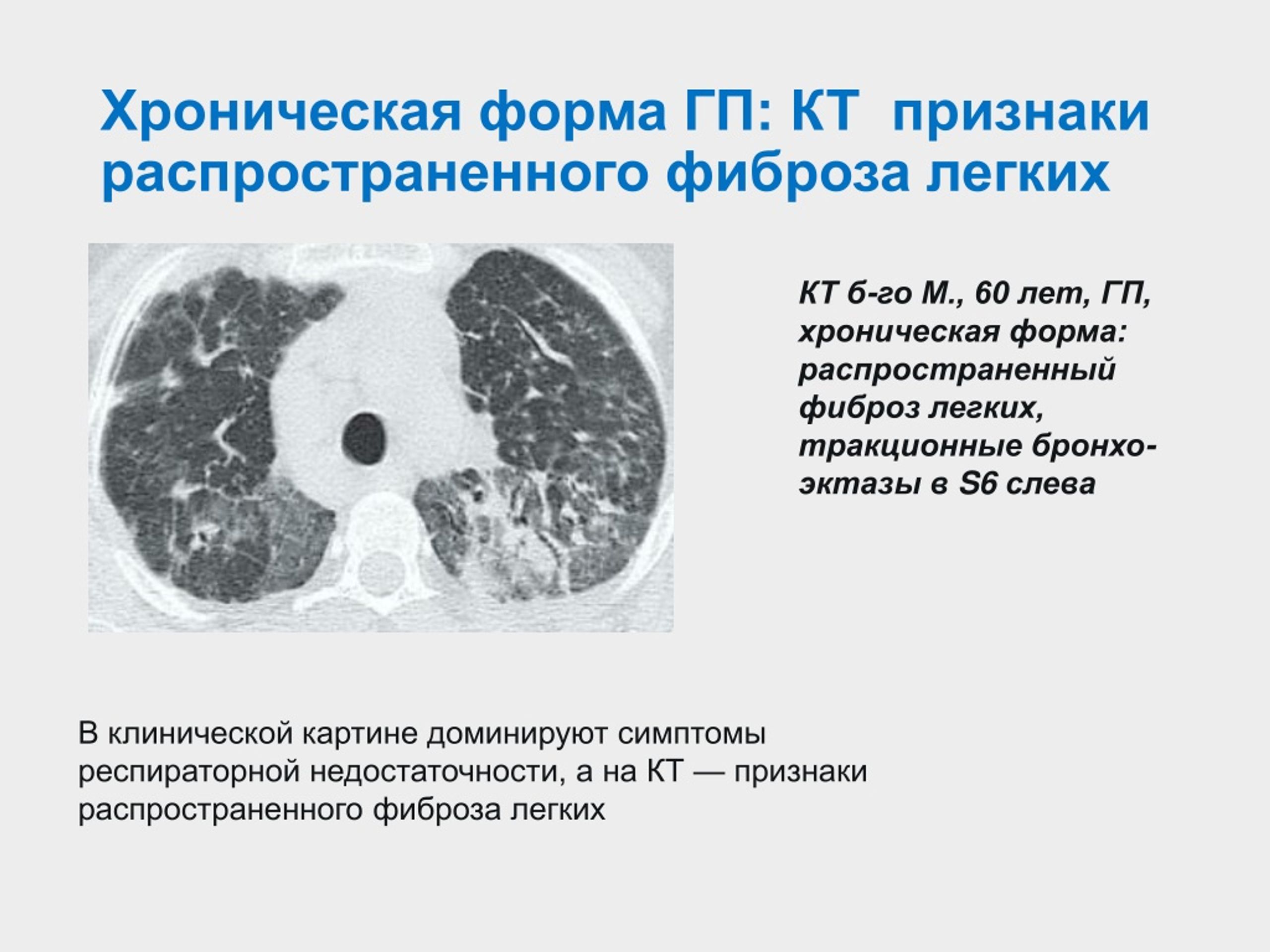 Умеренные фиброзные изменения. Интерстициальные заболевания легких кт. Фиброз лёгких на кт. Пневмофиброз на кт легких.