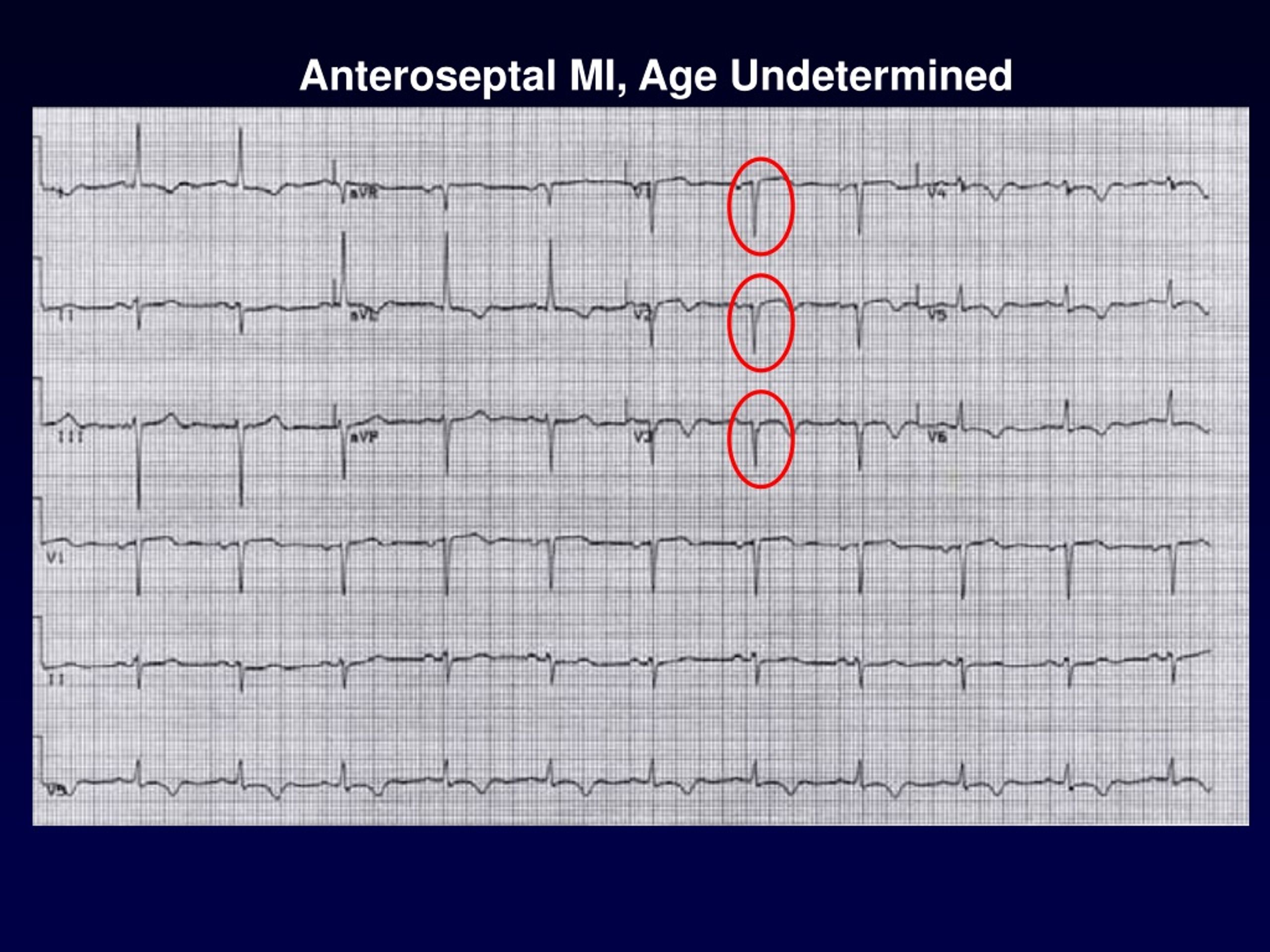 how-is-anteroseptal-myocardial-infarction-treated-on-secret-hunt