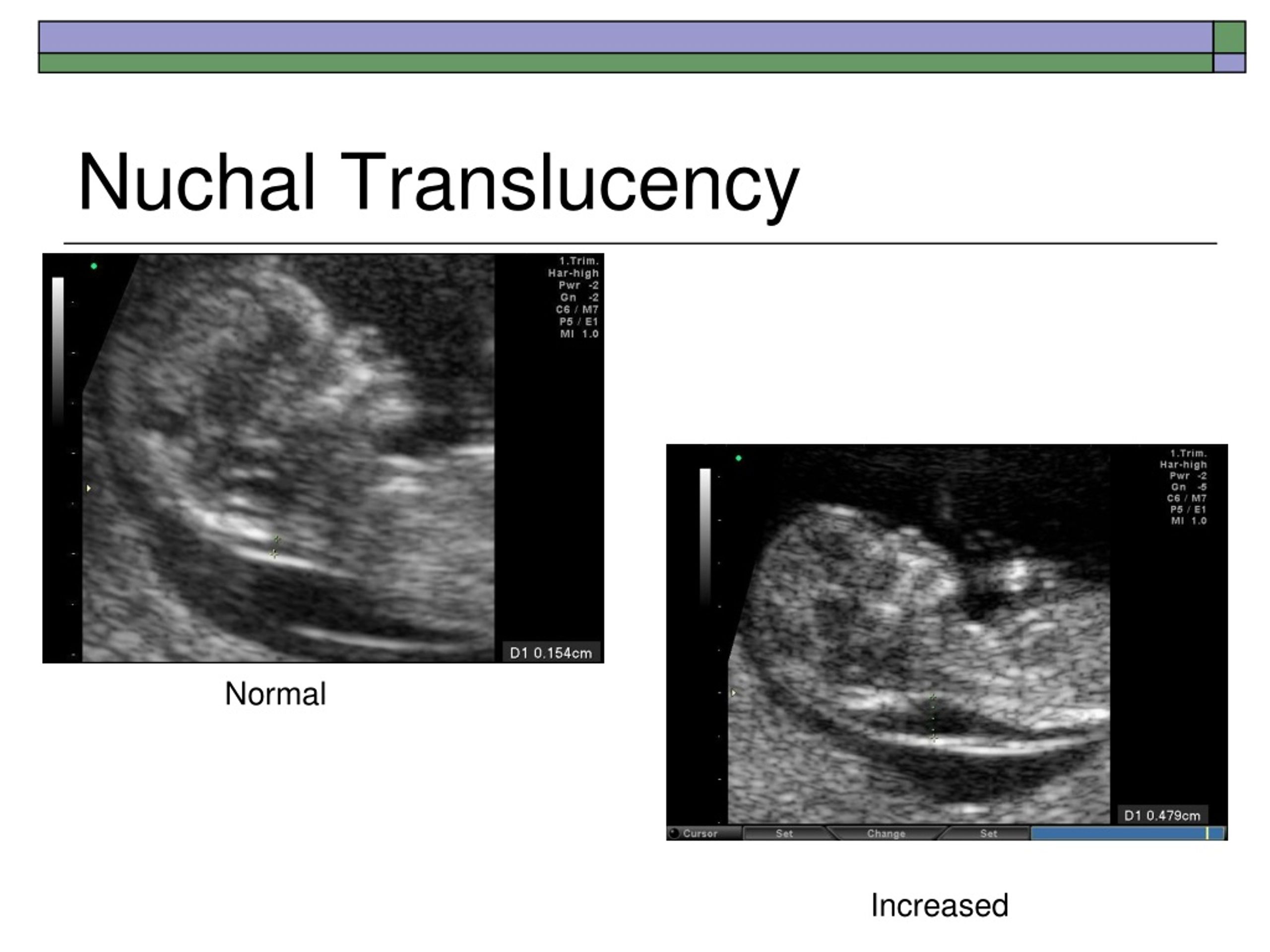 PPT Prenatal Screening And Diagnosis PowerPoint Presentation Free 