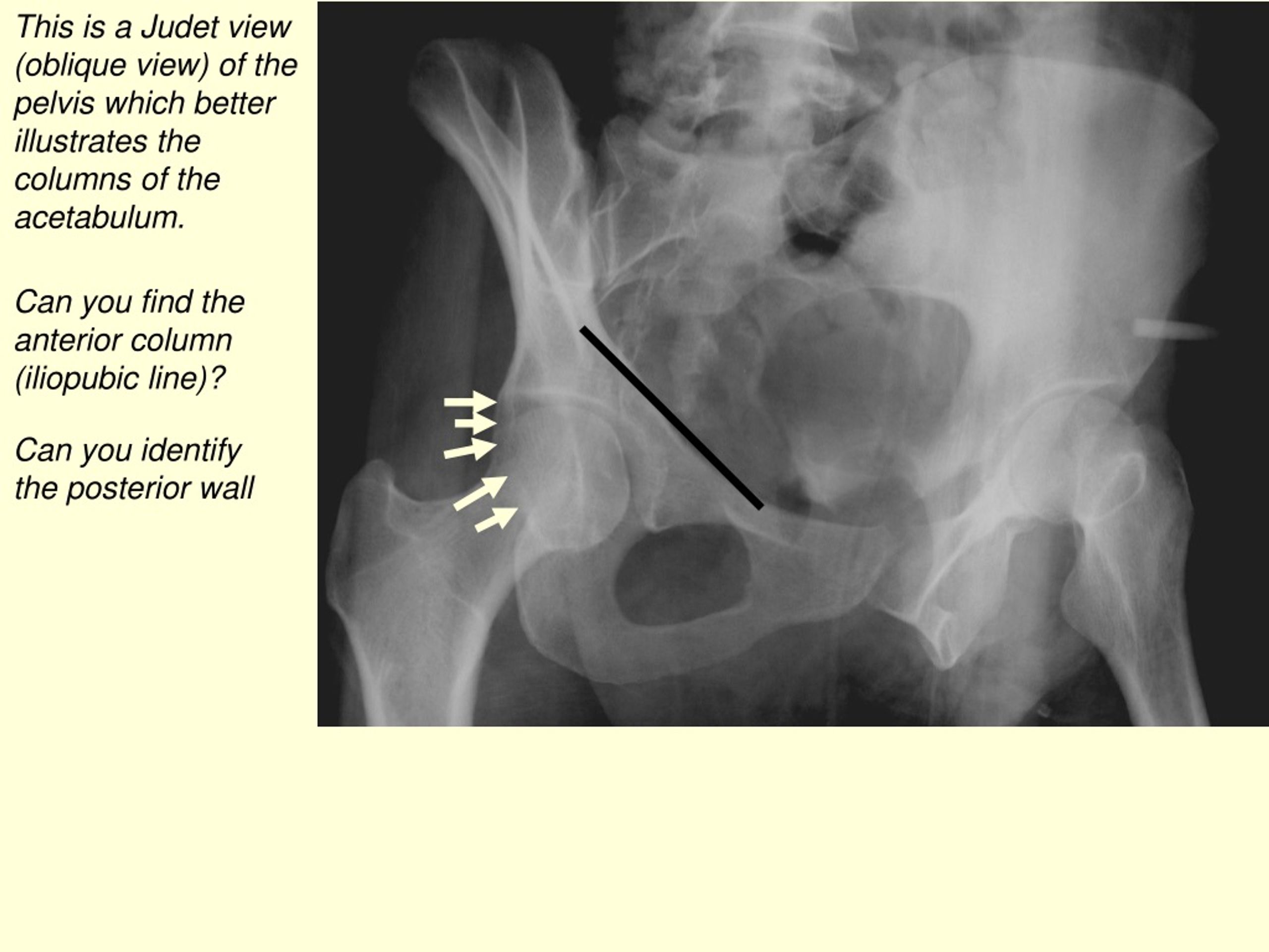 Ppt Lets Look At Some Muscle Anatomy In The Pelvis On Ct Scans