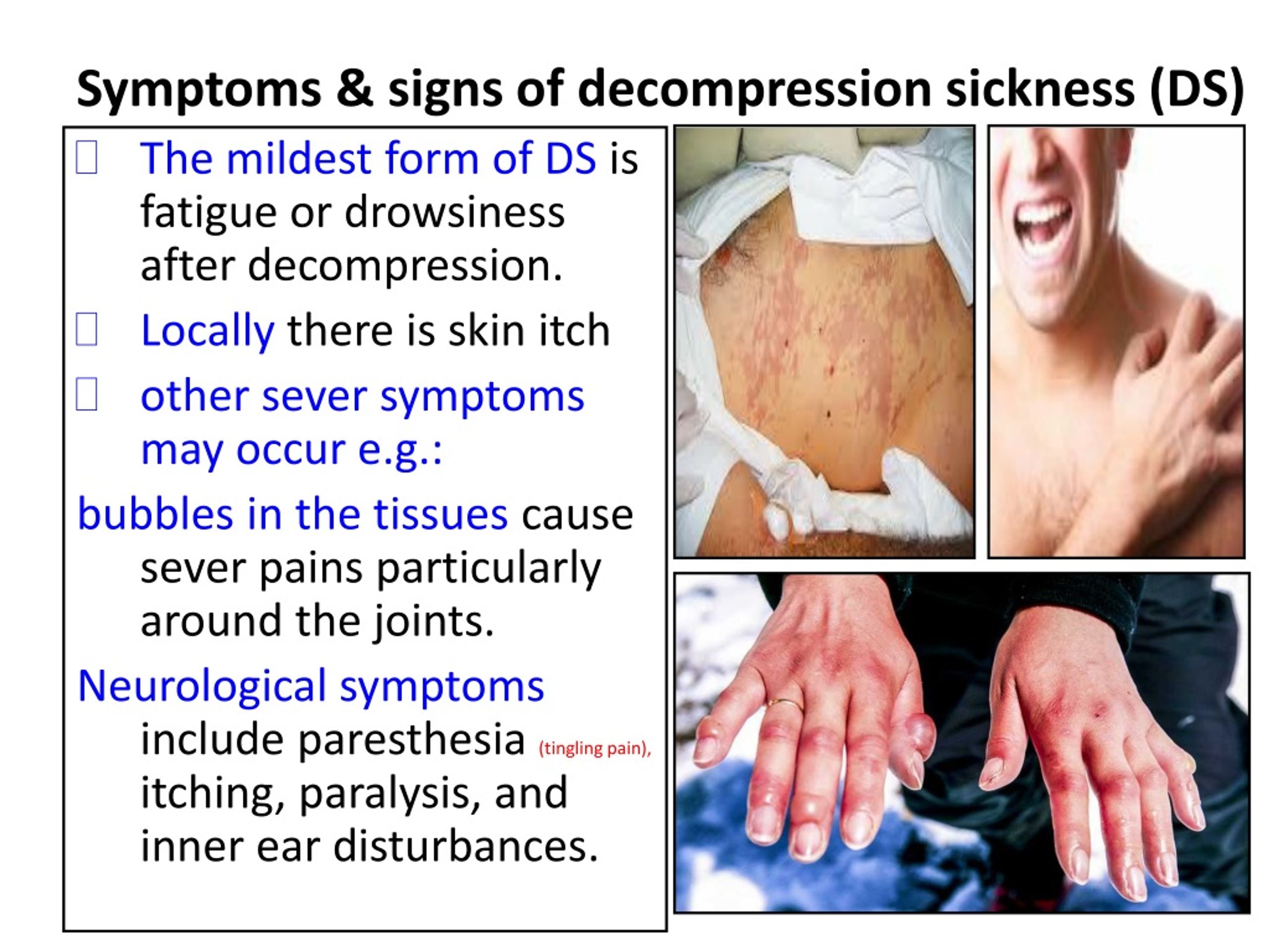 Symptoms Signs Of Decompression Sickness Ds L 