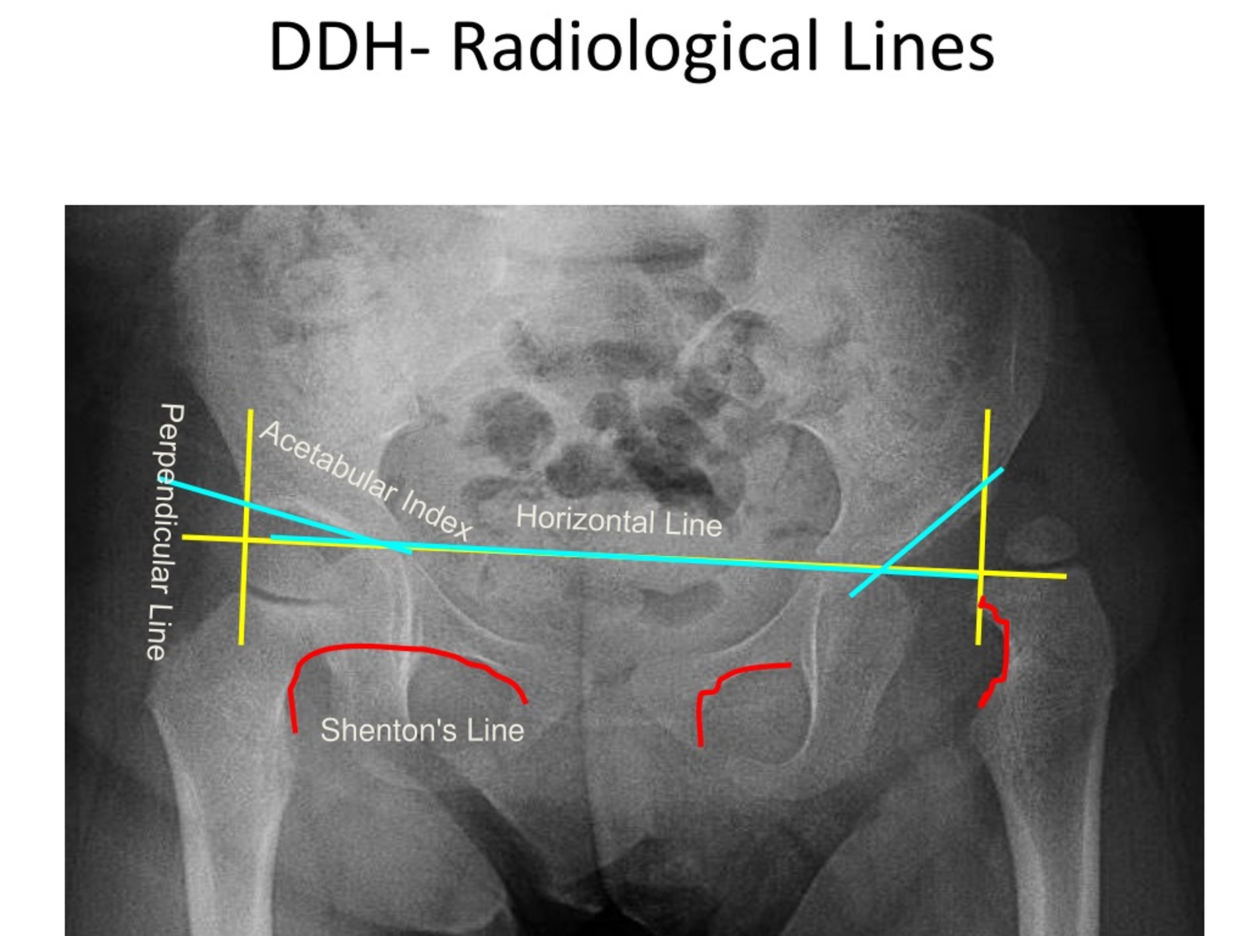 PPT Common Pediatric Hip Problems Causes Diagnosis Treatment 