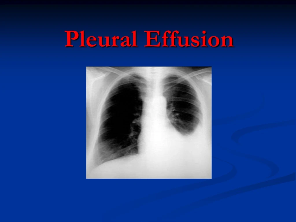 pleural effusion n.