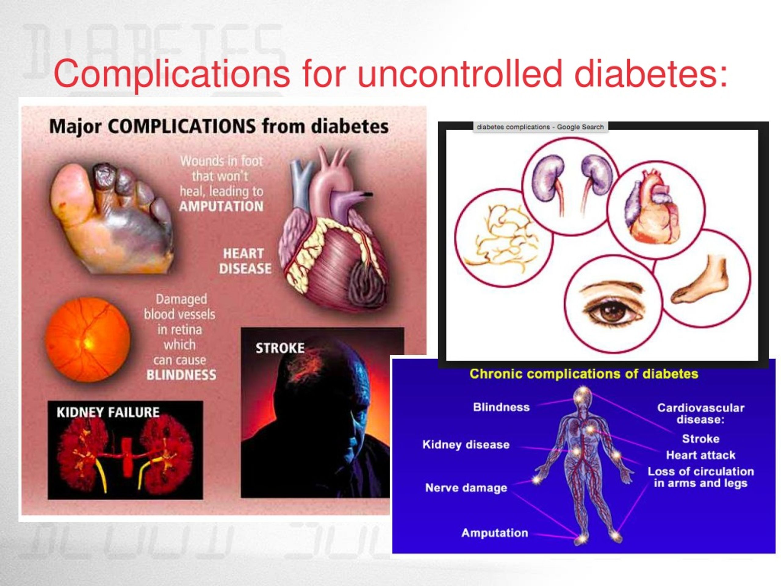 atypical presentation of mi in diabetes