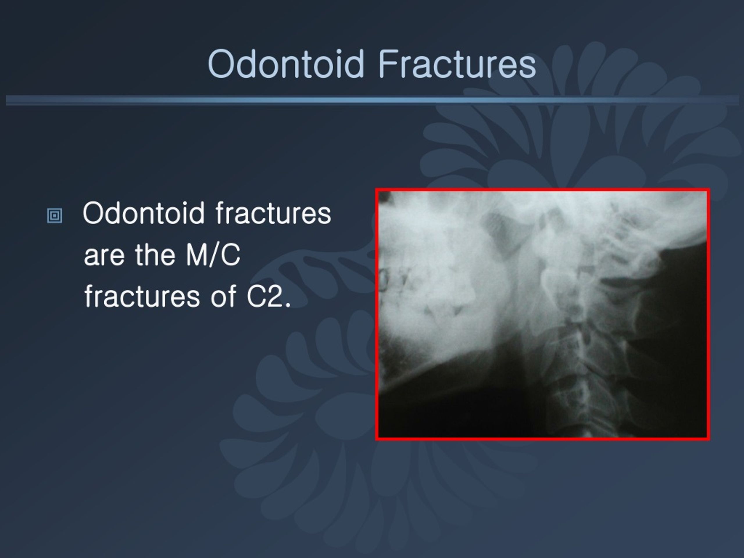 icd10 diagnosis for odontoid fracture type 2