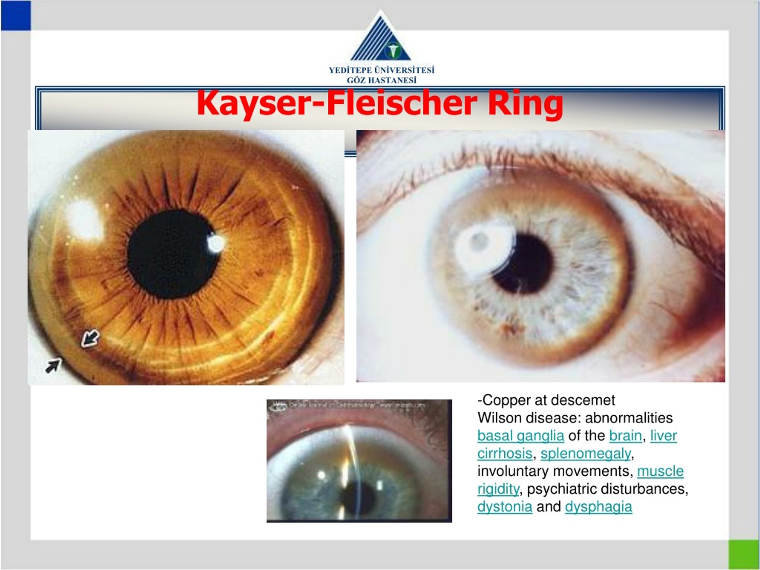 Kayser-Fleischer ring in eye due to … – Bild kaufen – 12969887 ❘ Science  Photo Library