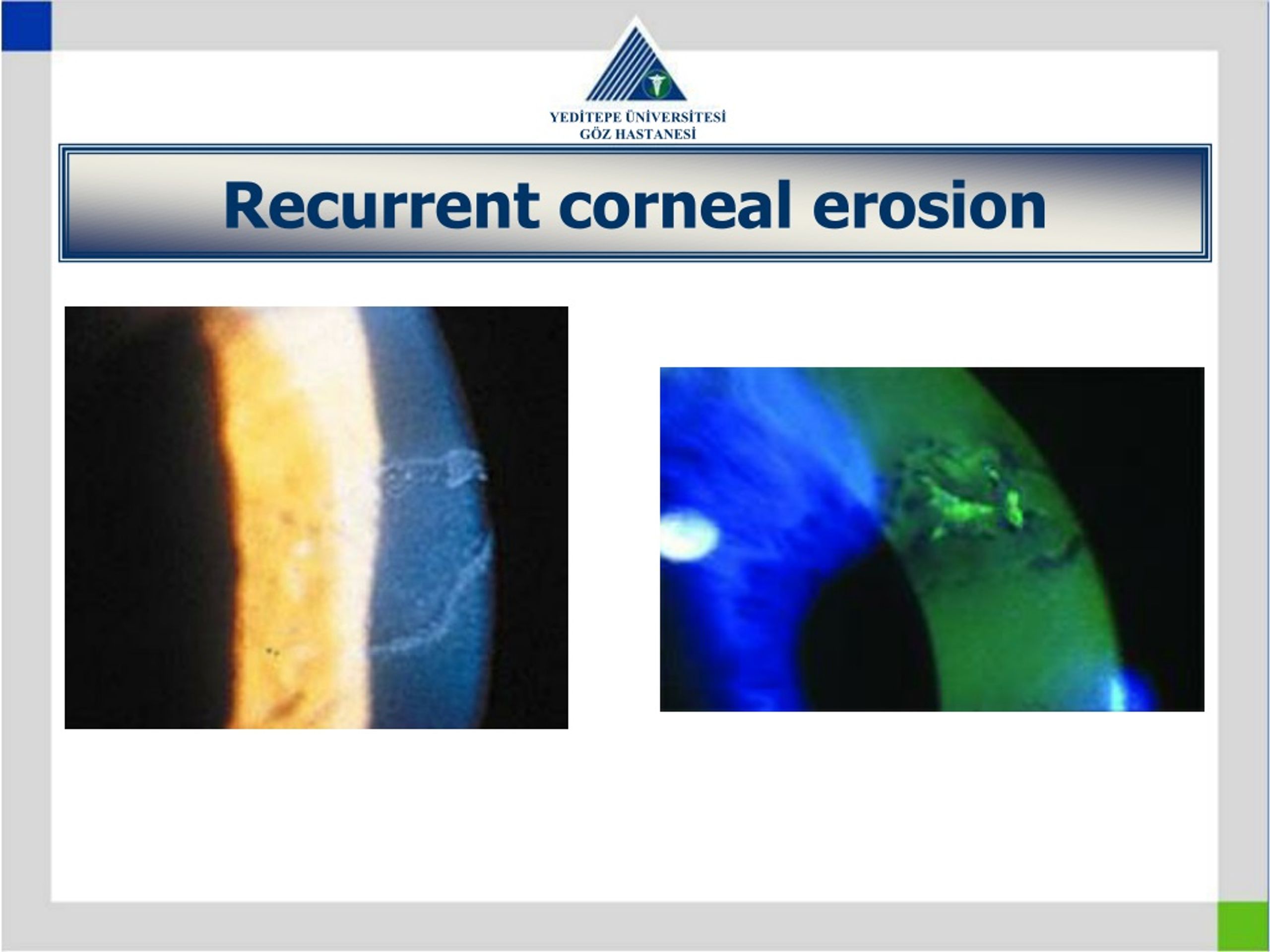 Ppt Disorders Of The Conjunctiva And Cornea Powerpoint Presentation Id9188086 