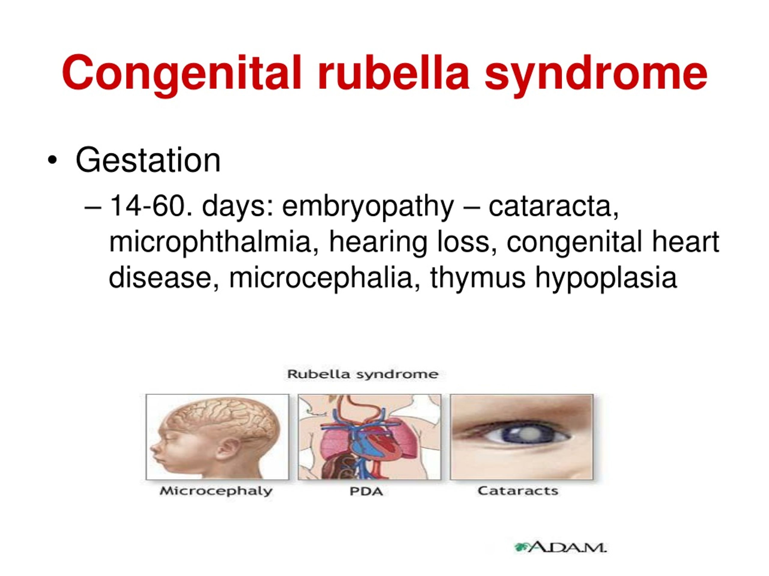 congenital rubella pda