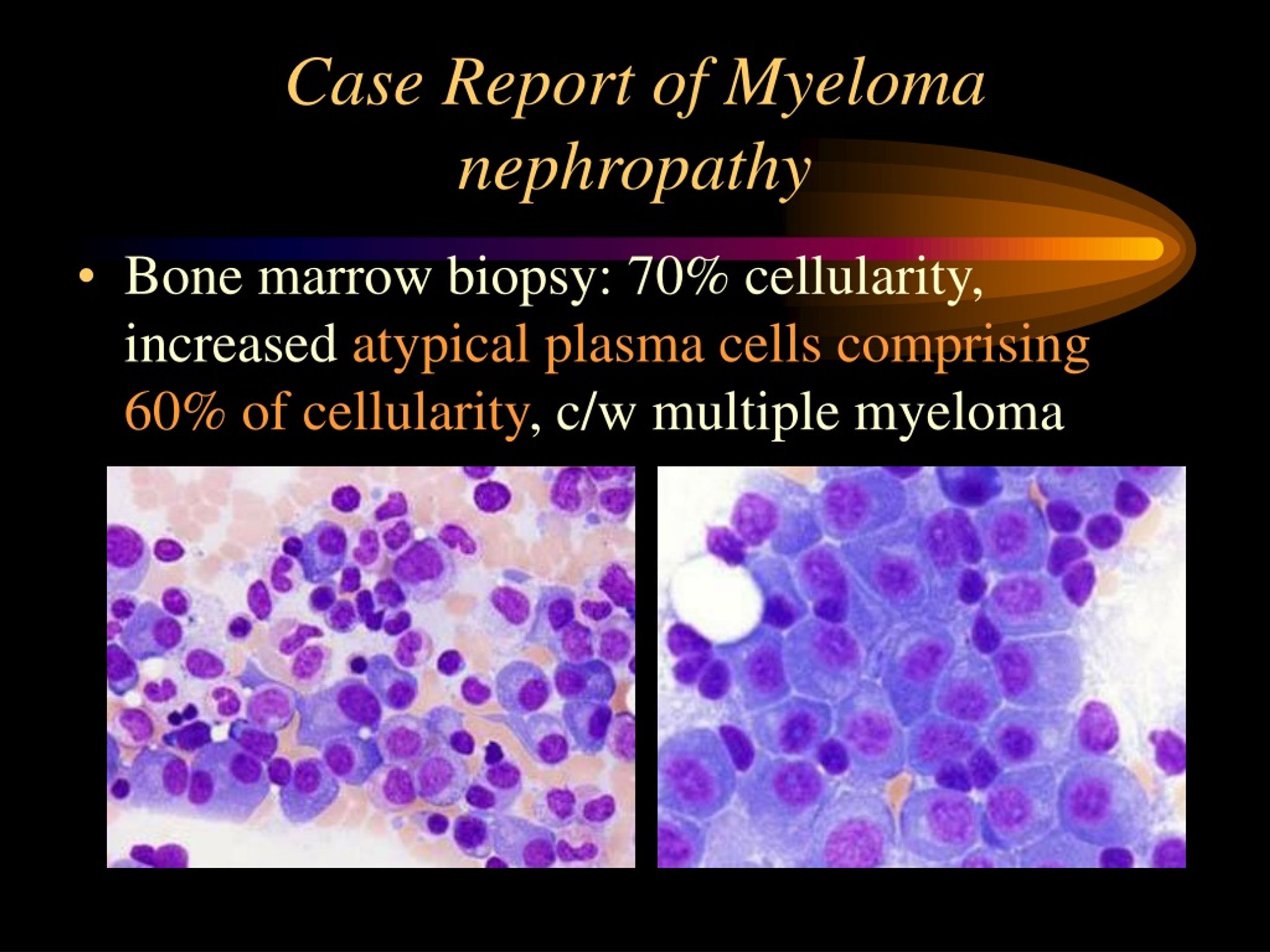 Ppt Multiple Myeloma Powerpoint Presentation Free Download Id9200824 