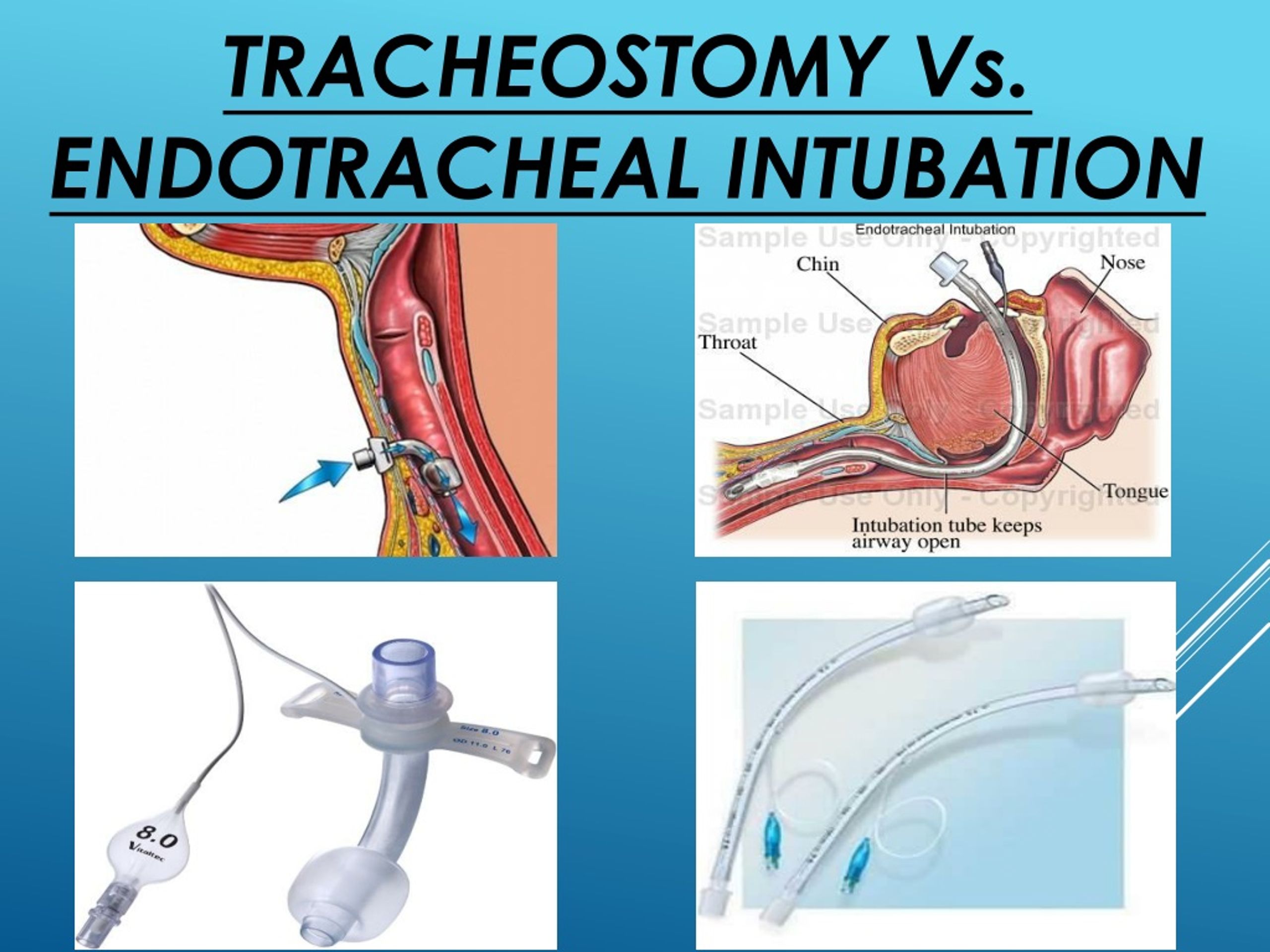 PPT ‘RotaTrach™ ’ Double Lumen Tracheostomy Tube PowerPoint Presentation ID9205344