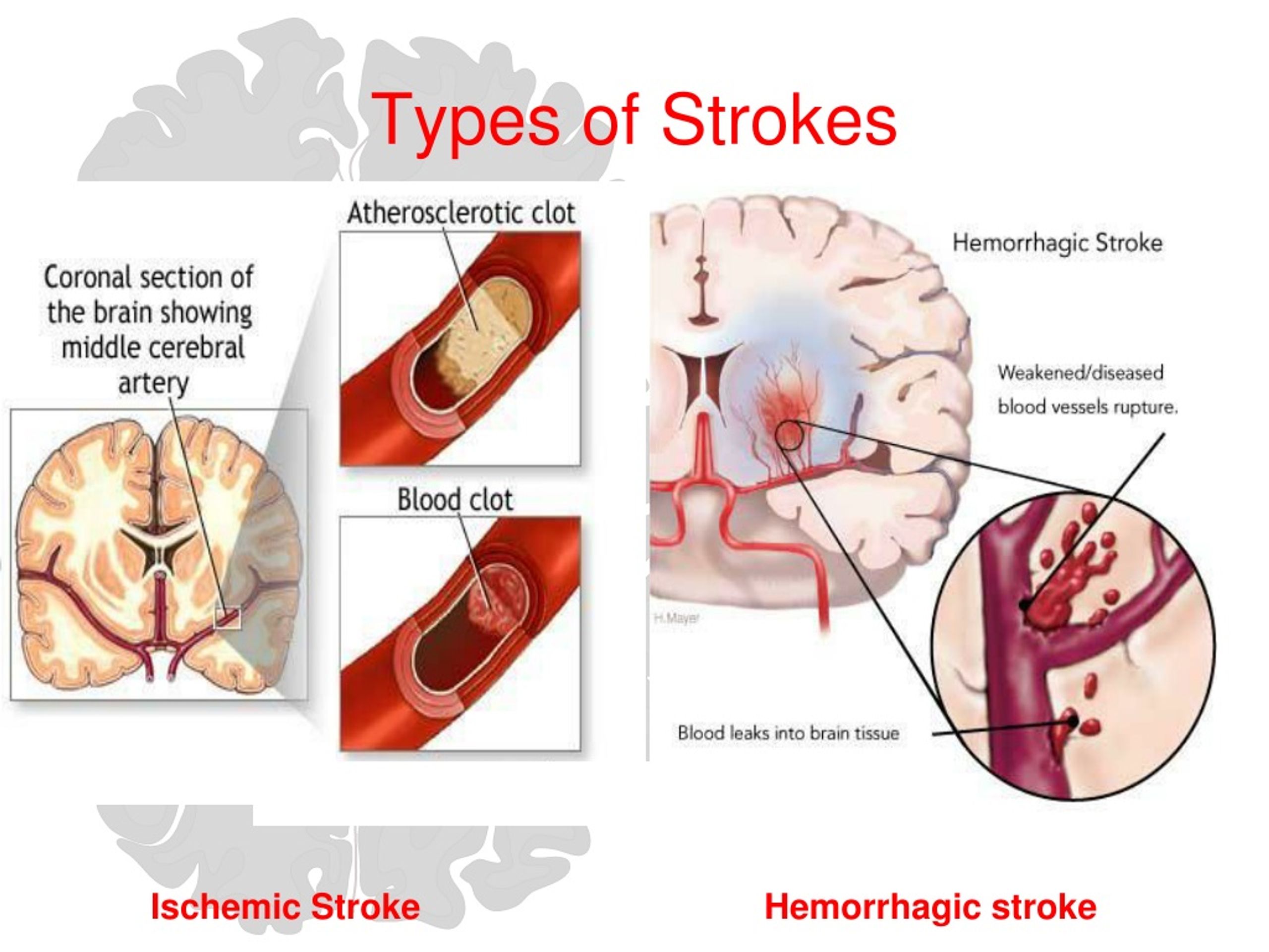 PPT - Care of the Stroke Patient Improving Patient Outcomes PowerPoint ...