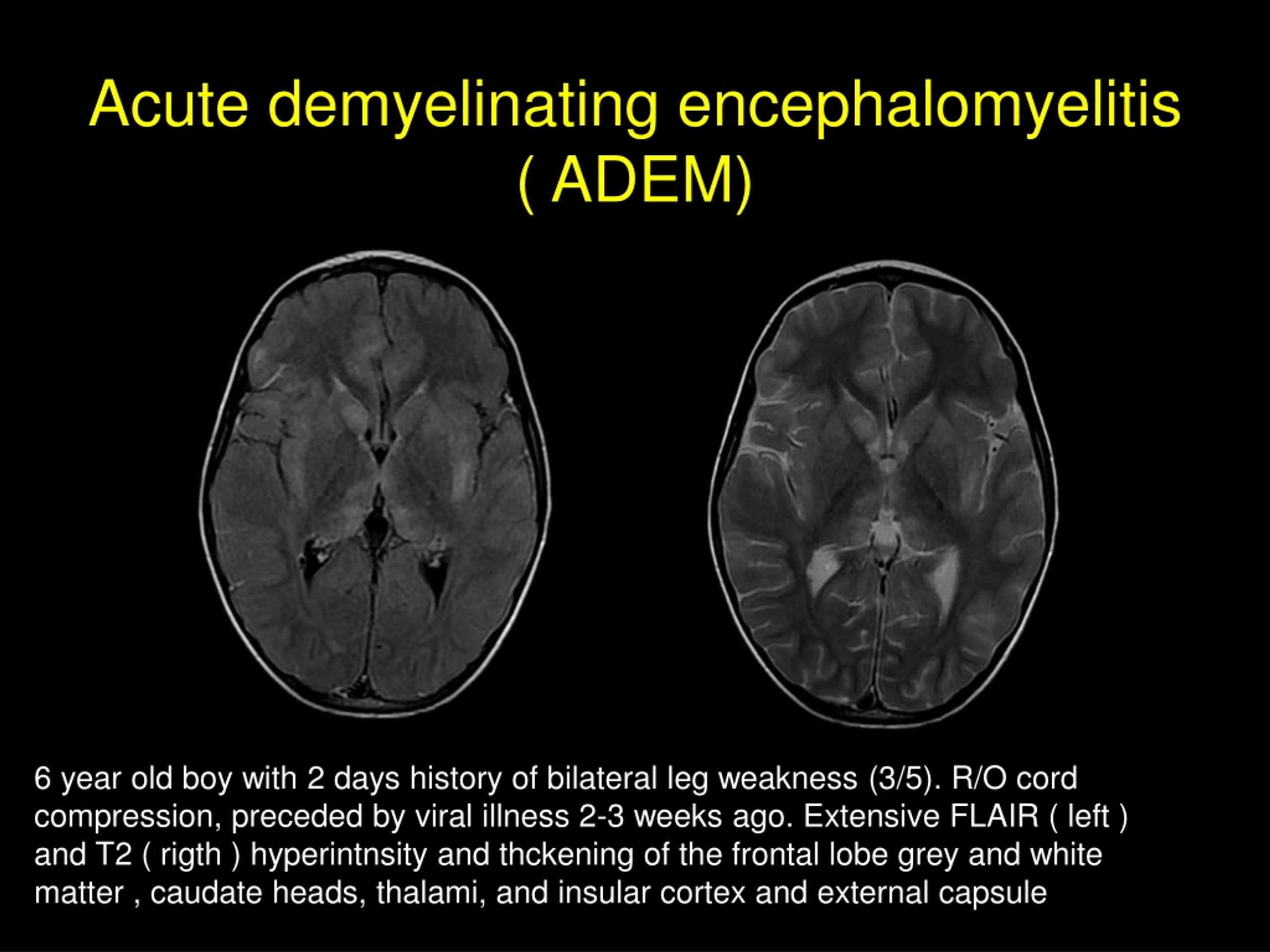 PPT - MR Imaging Of Encephalitis In Children: Infectious, Noninfectious ...