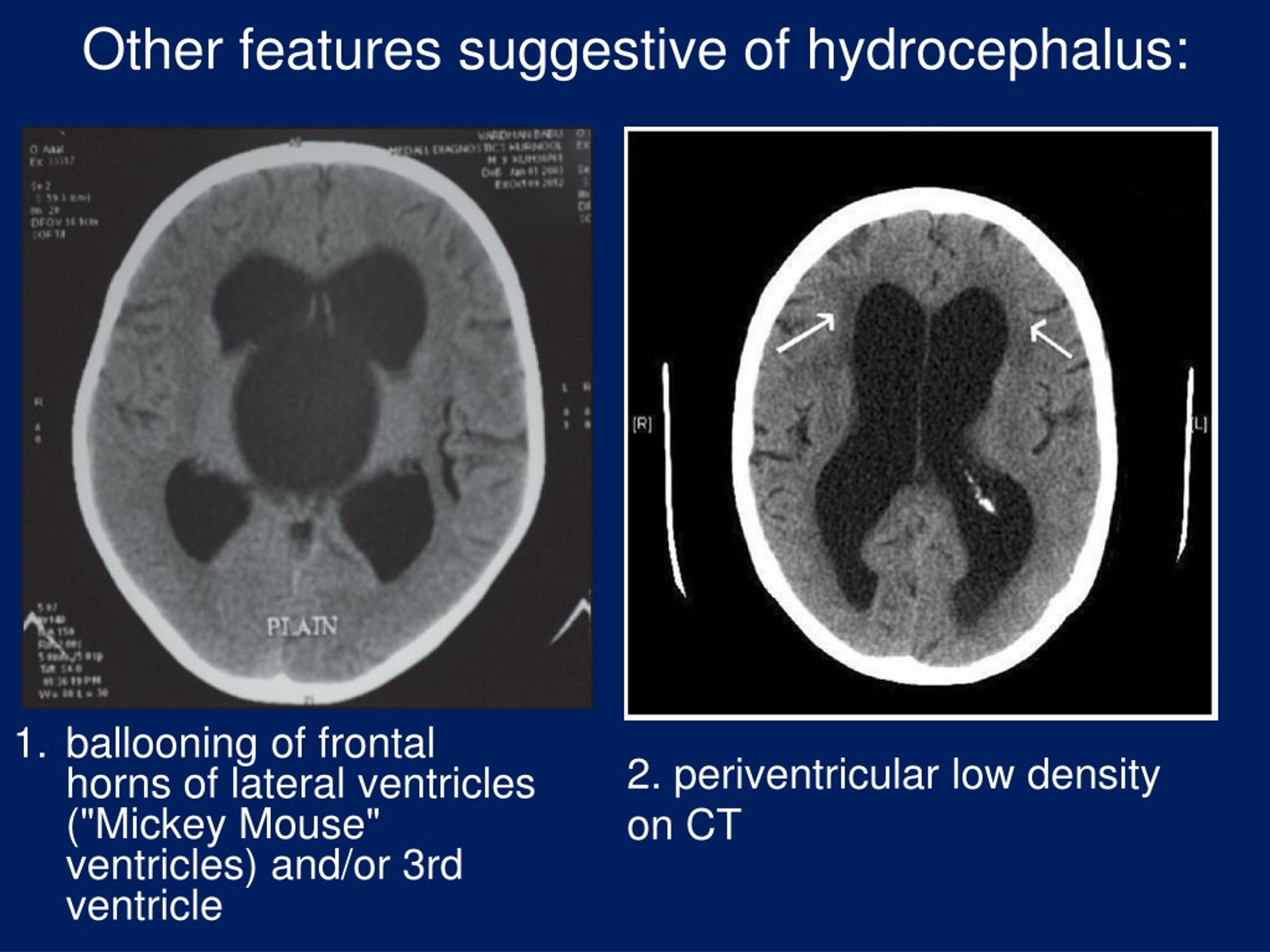 Ppt Hydrocephalus Ventriculo Peritoneal Shunt Powerpoint Presentation Id9224266 6308