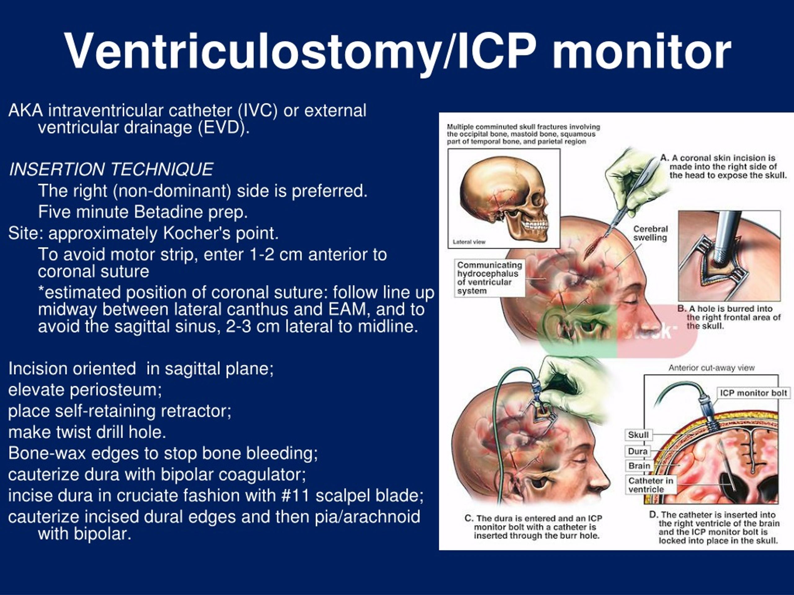 Ppt Hydrocephalus Ventriculo Peritoneal Shunt Powerpoint Presentation Id9224266 1104