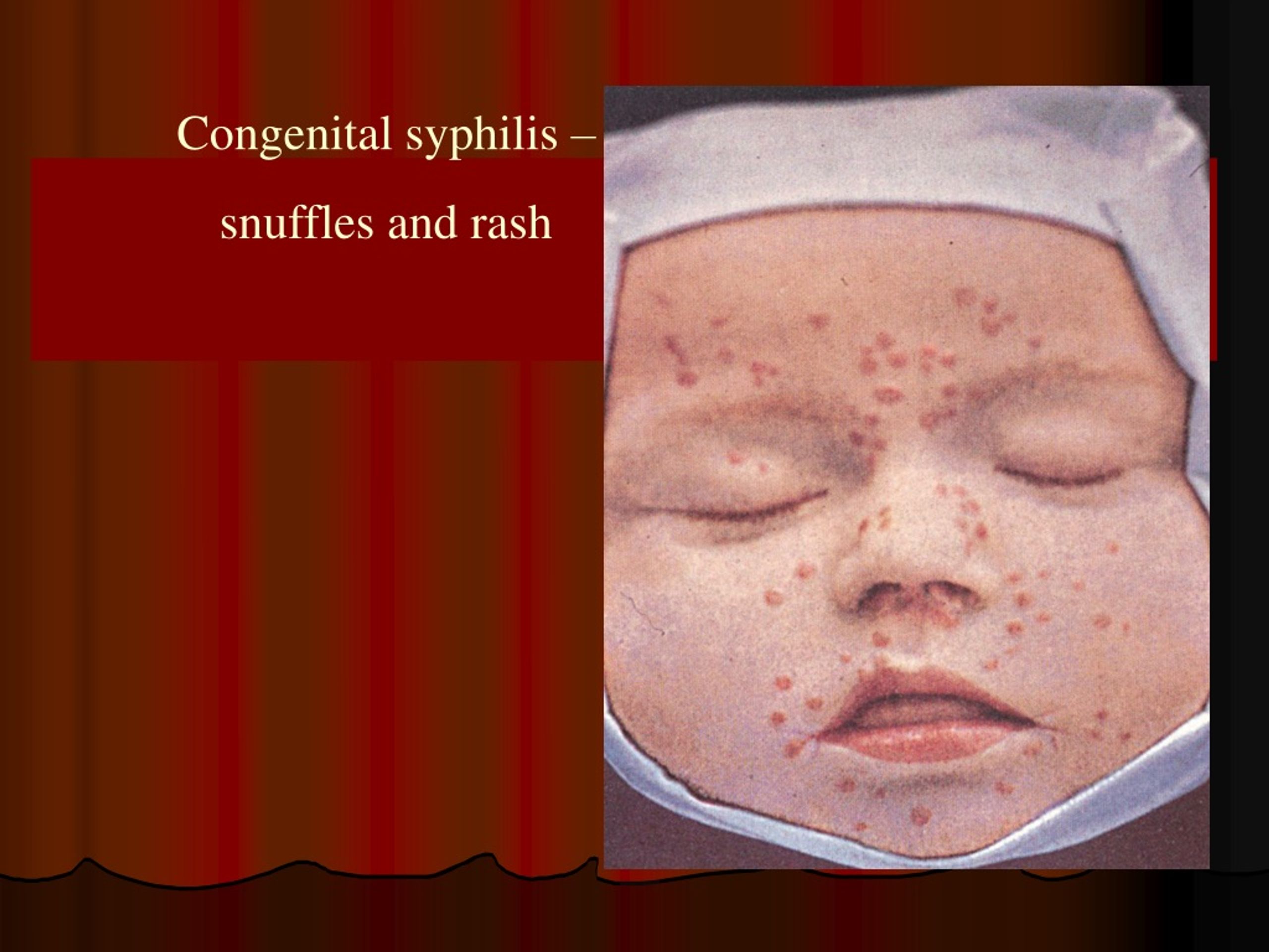 presentation of syphilis patients