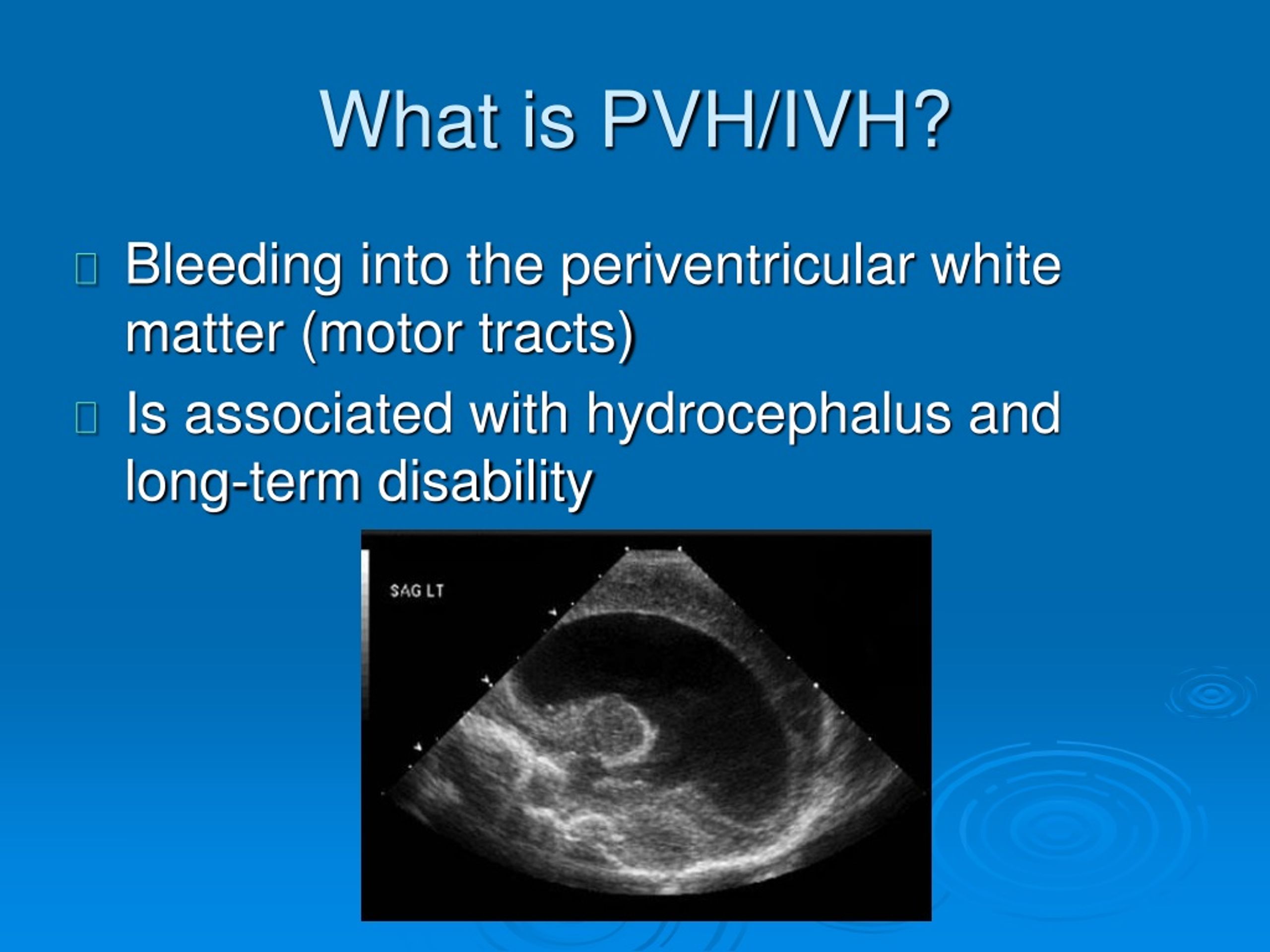 Ppt Periventricular And Intraventricular Hemorrhage In The Neonate