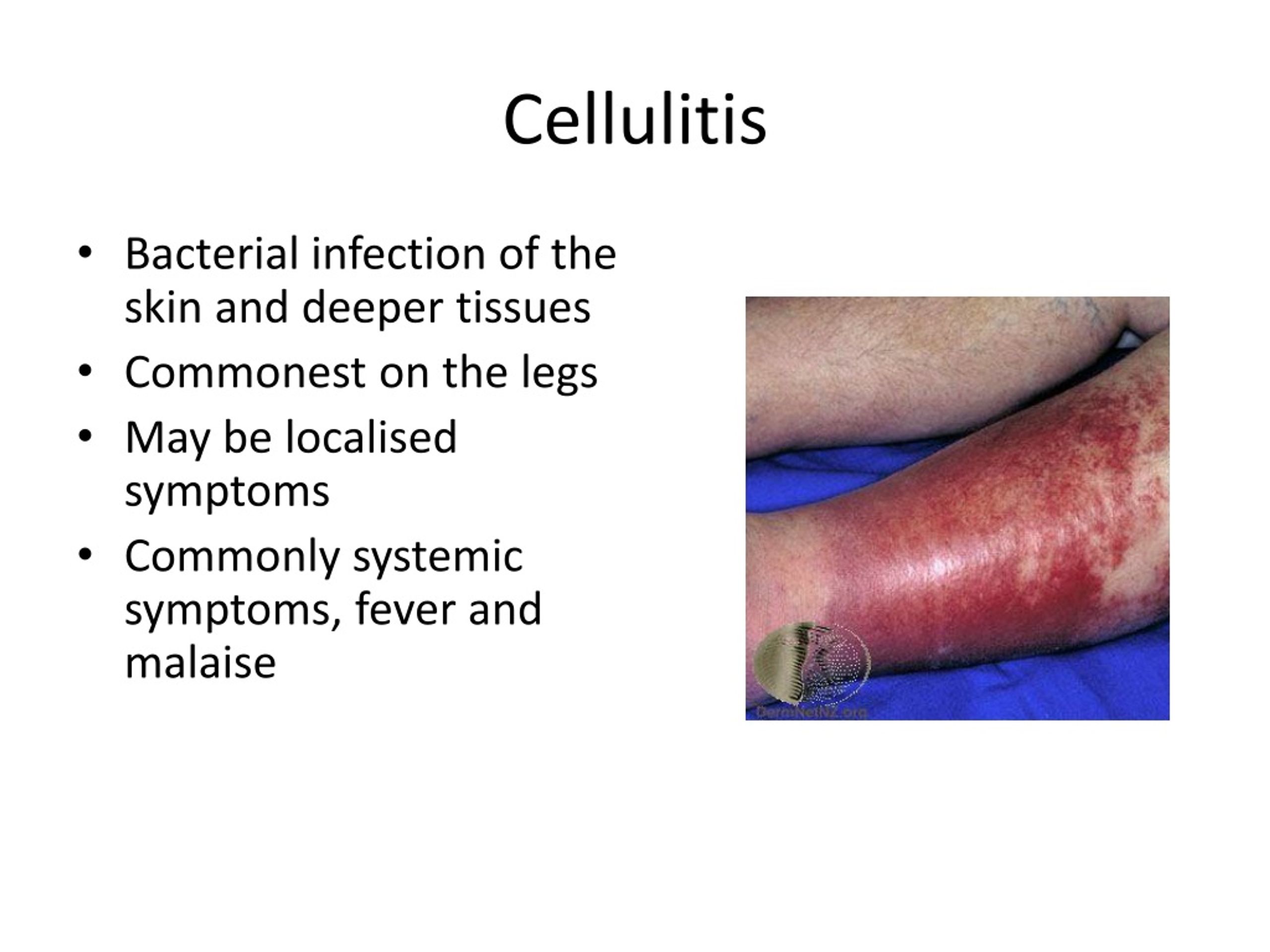 PPT Skin Infections Impetigo Cellulitis And More PowerPoint 