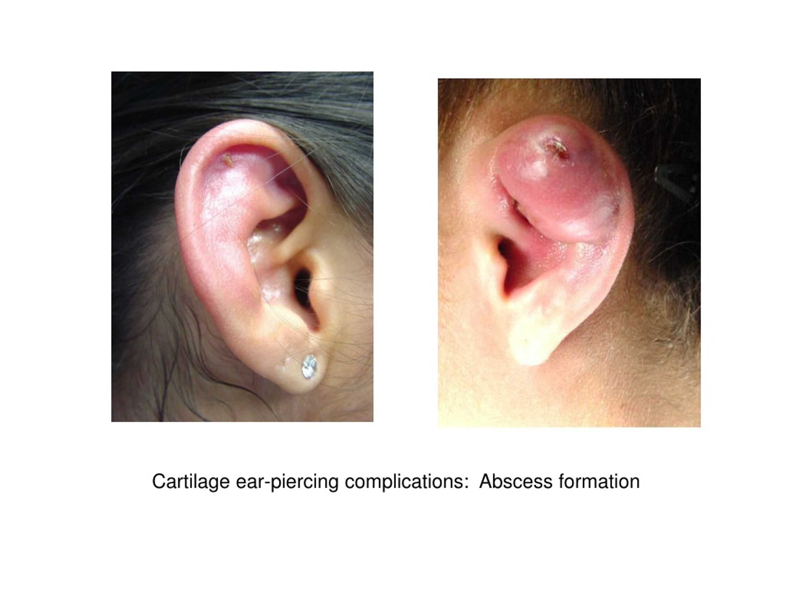 Ear Piercing Abscess Treatment.html