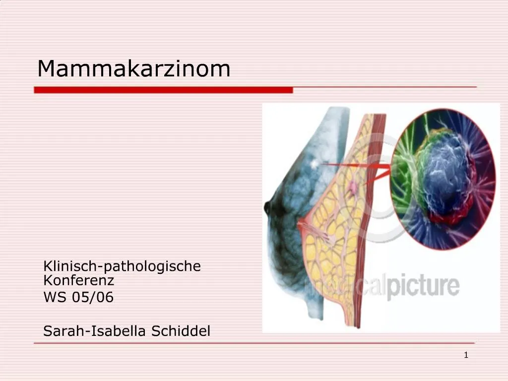 PPT - Mammakarzinom PowerPoint Presentation, Free Download - ID:962234